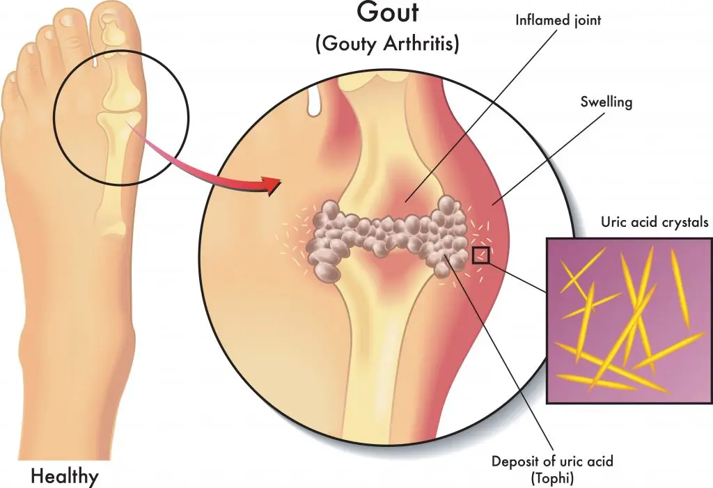 โรคเกาต์เกิดขึ้นได้อย่างไร ห้ามกินอาหารอะไร