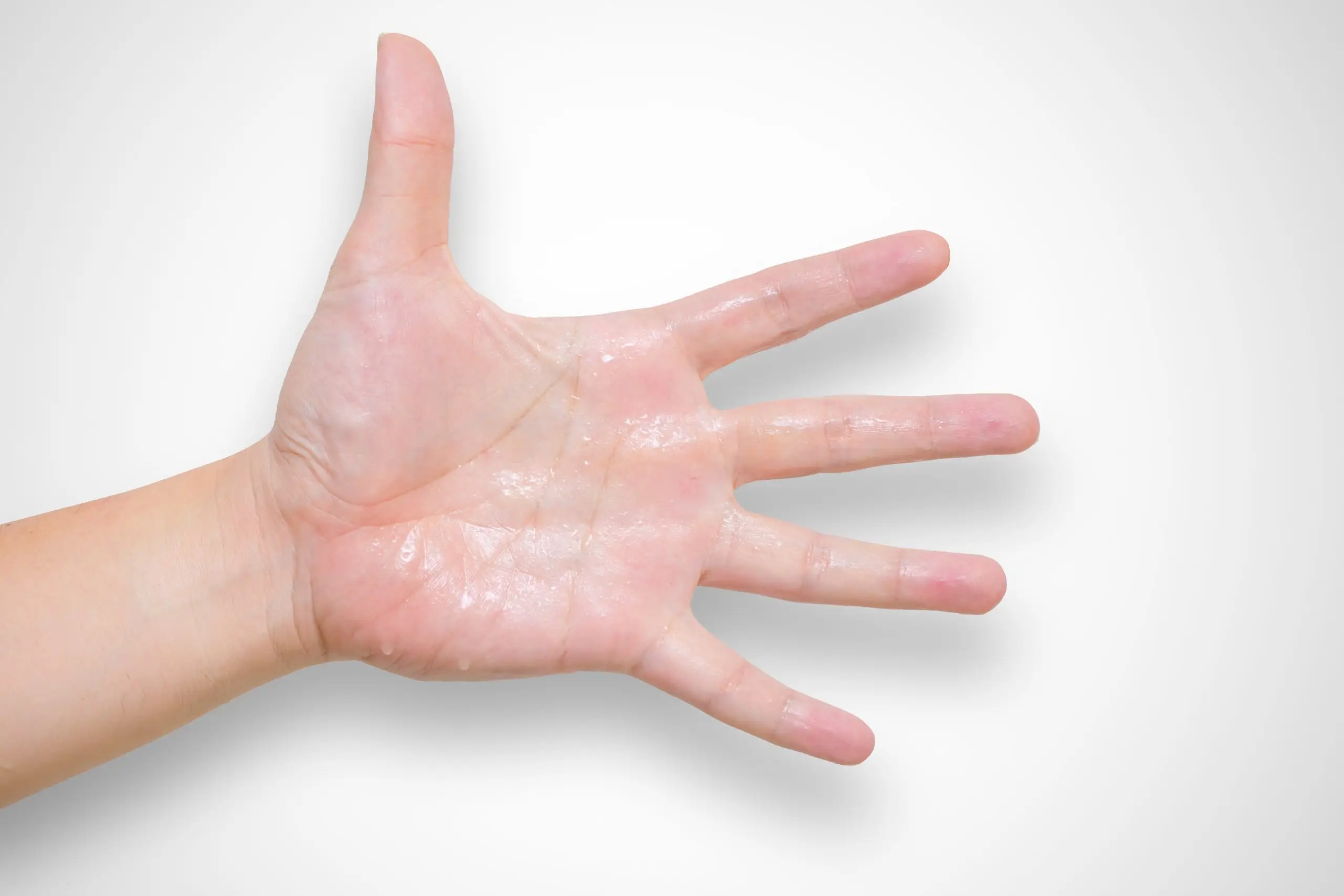 hyperhidrosis sign disease definition scaled