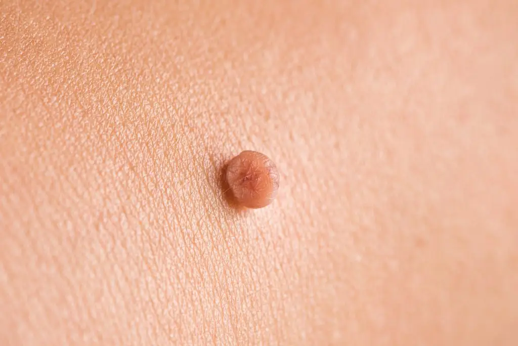 ติ่งเนื้อ (Multiple skin tags) ข้อมูลโรค อาการ รักษา