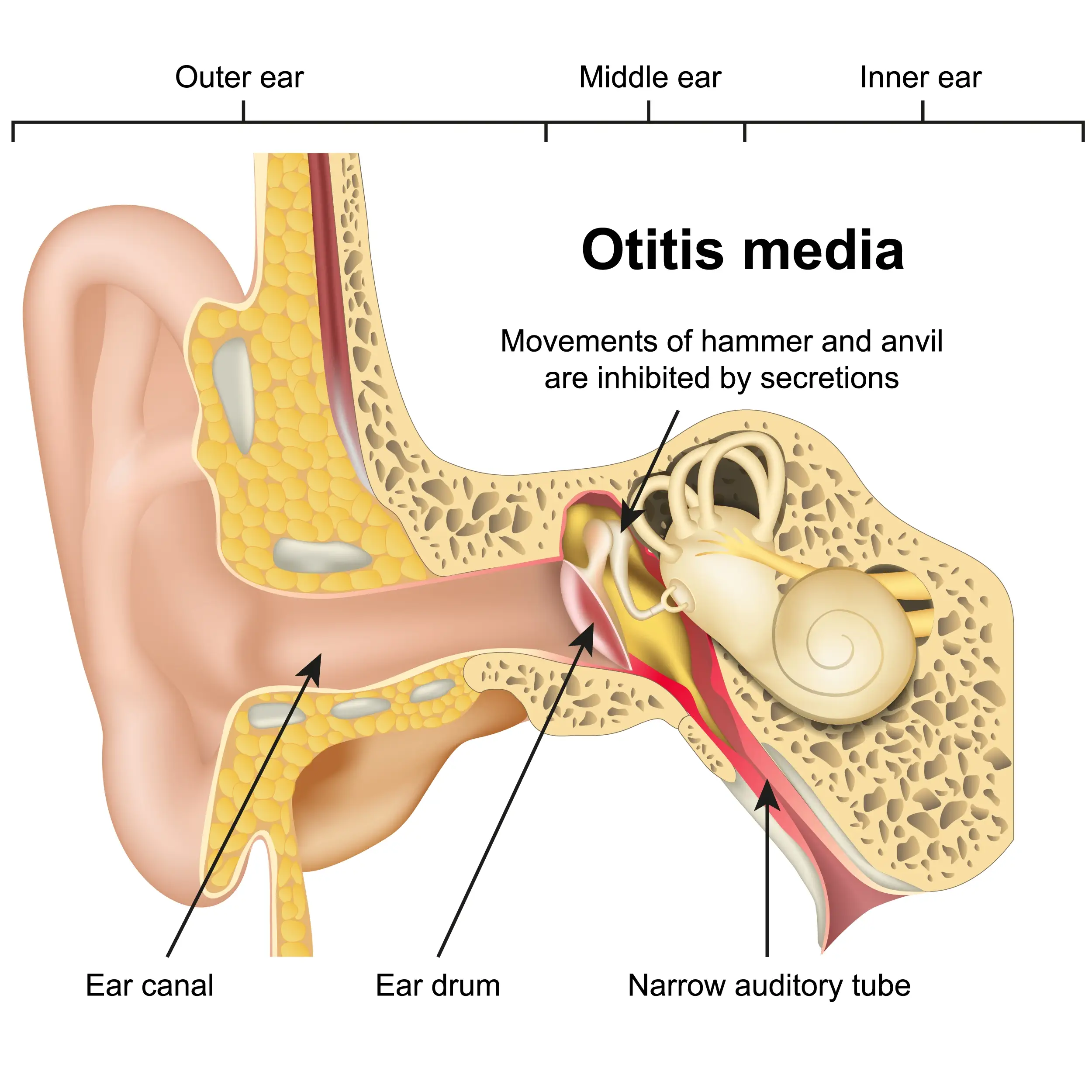 otitis media