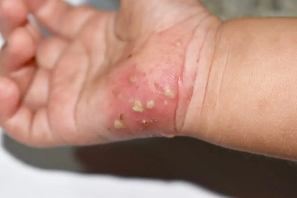 โรคหิด (Scabies)