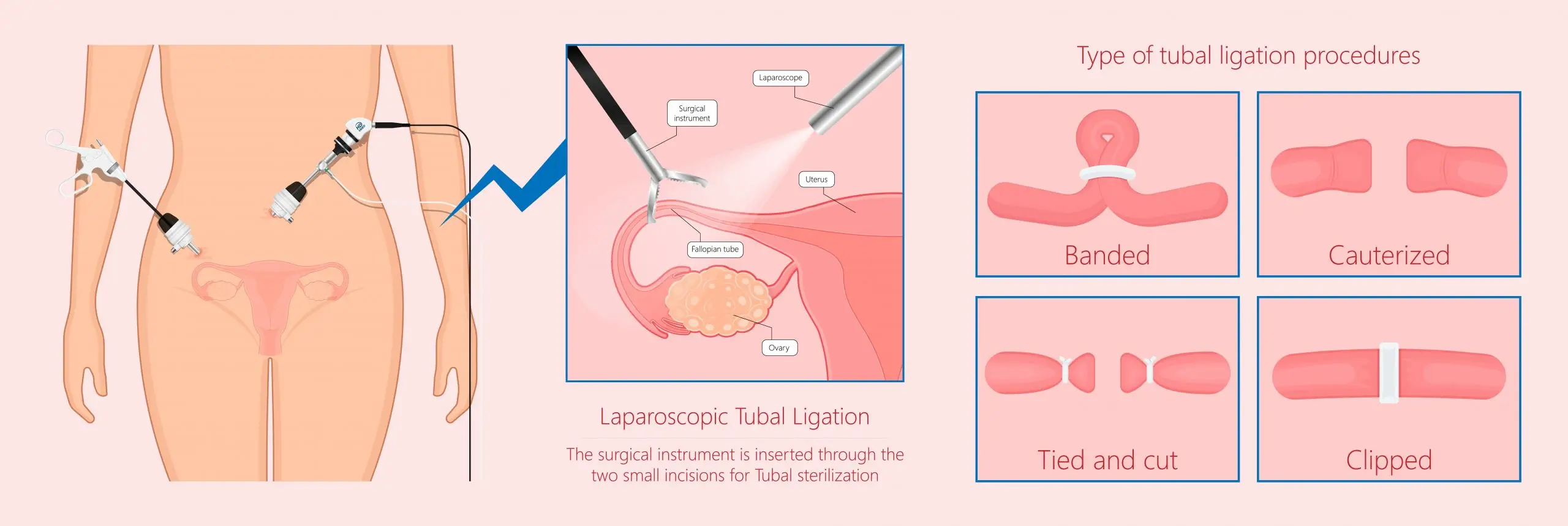 sterilization disease definition 02 scaled