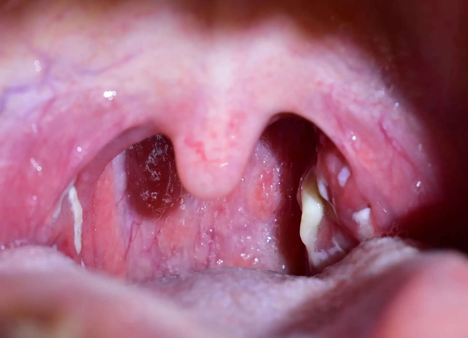 tonsil disease definition 02