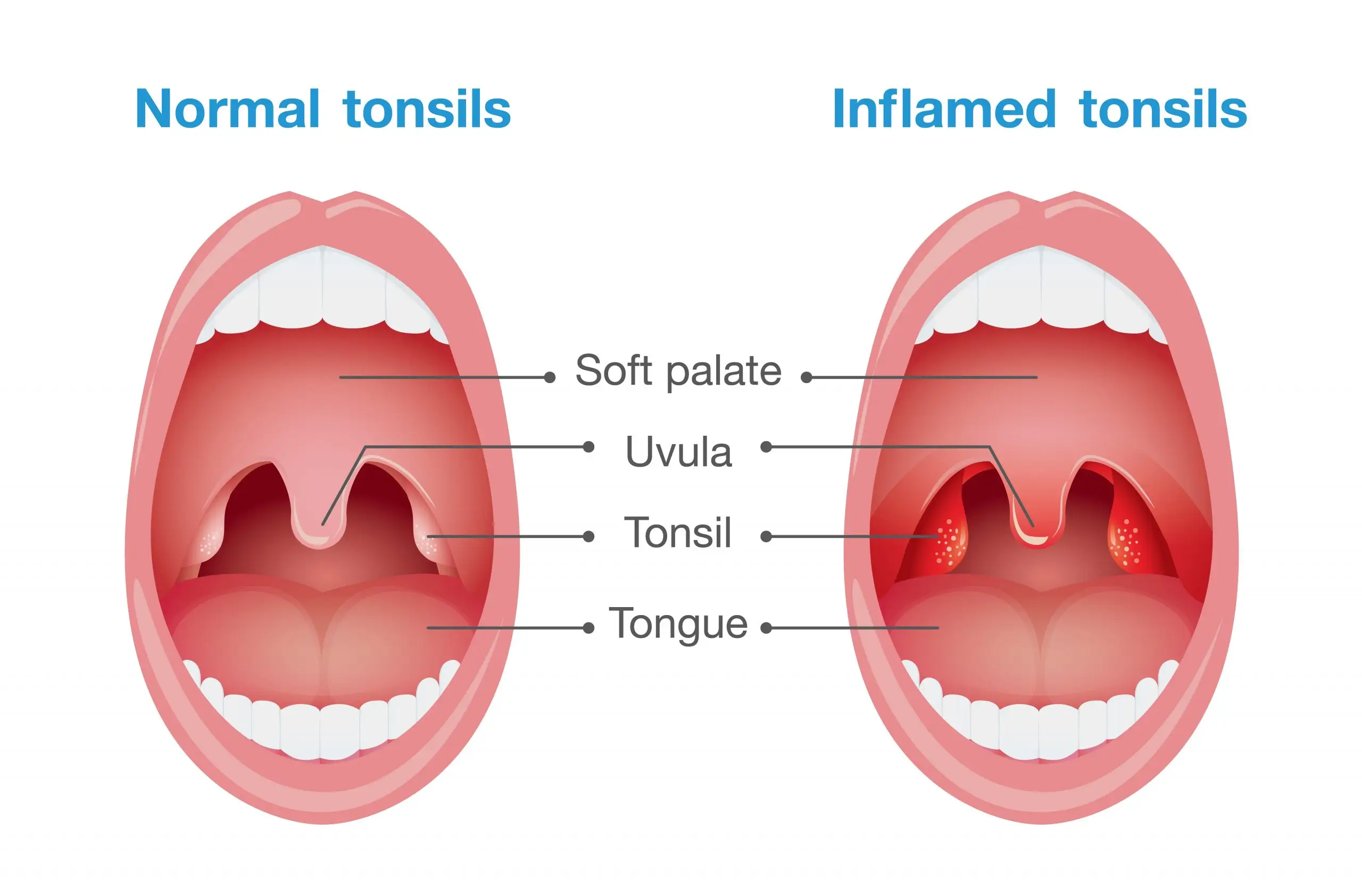 tonsil disease definition scaled