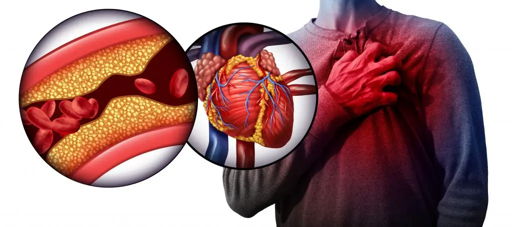 กล้ามเนื้อหัวใจขาดเลือด (Myocardial infarction)