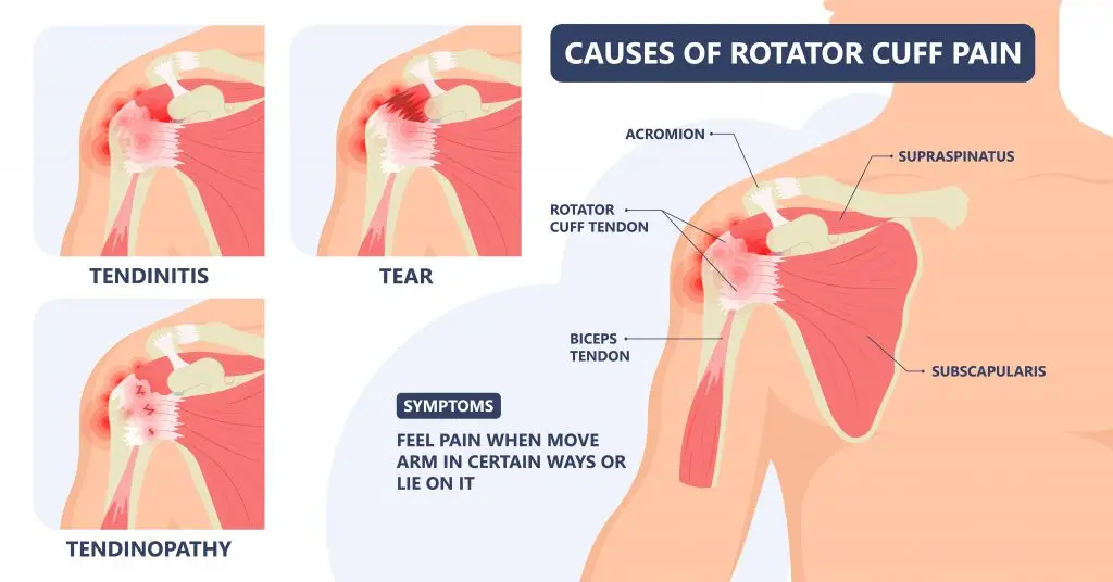 กายภาพบำบัดในผู้ป่วย เอ็นข้อไหล่อักเสบ (Shoulder tendonitis)