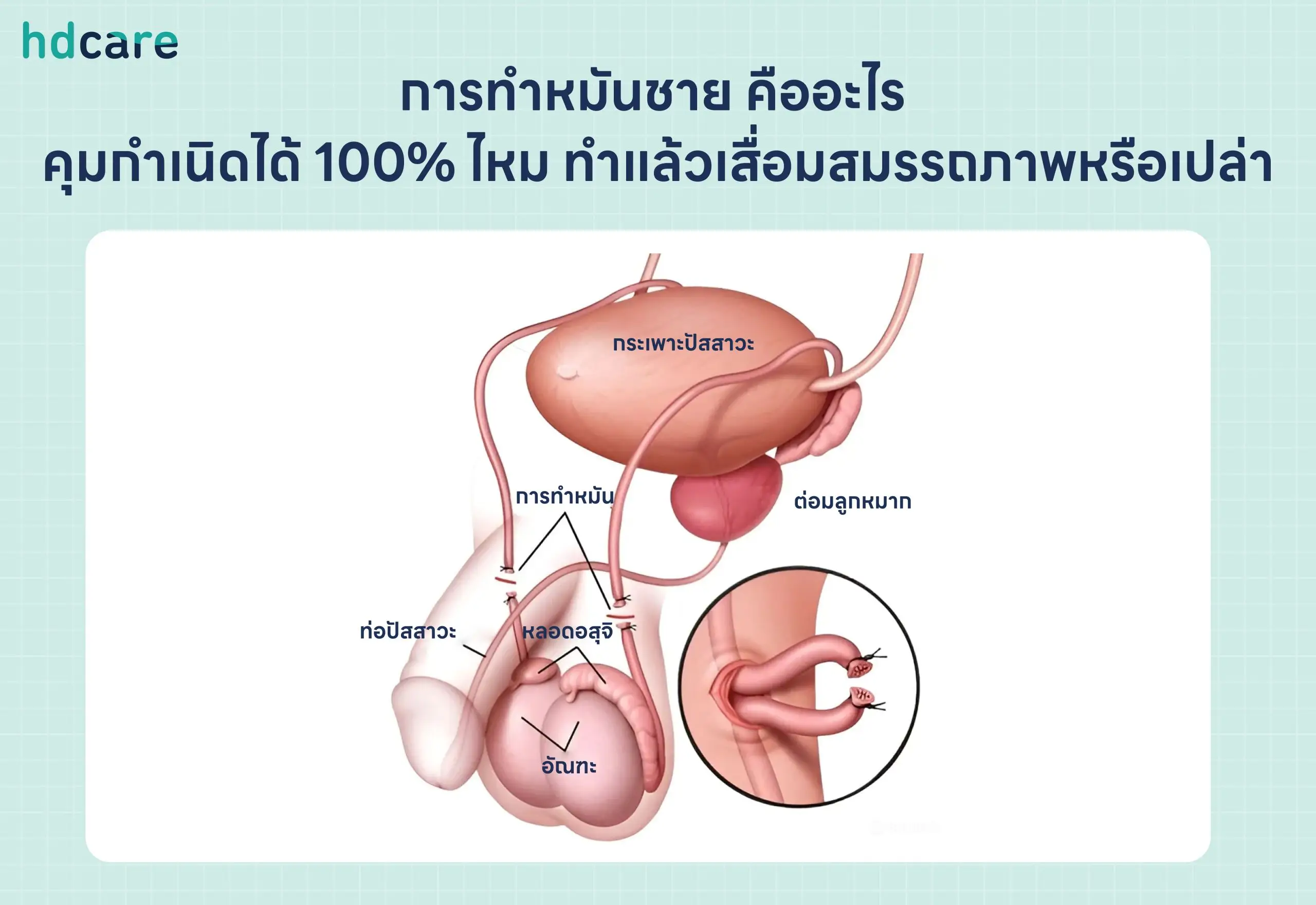 การทำหมันชาย