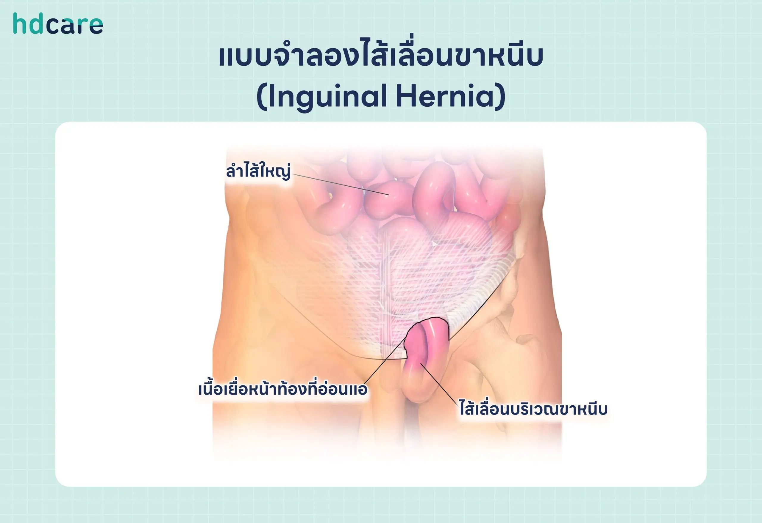 ไส้เลื่อนขาหนีบ