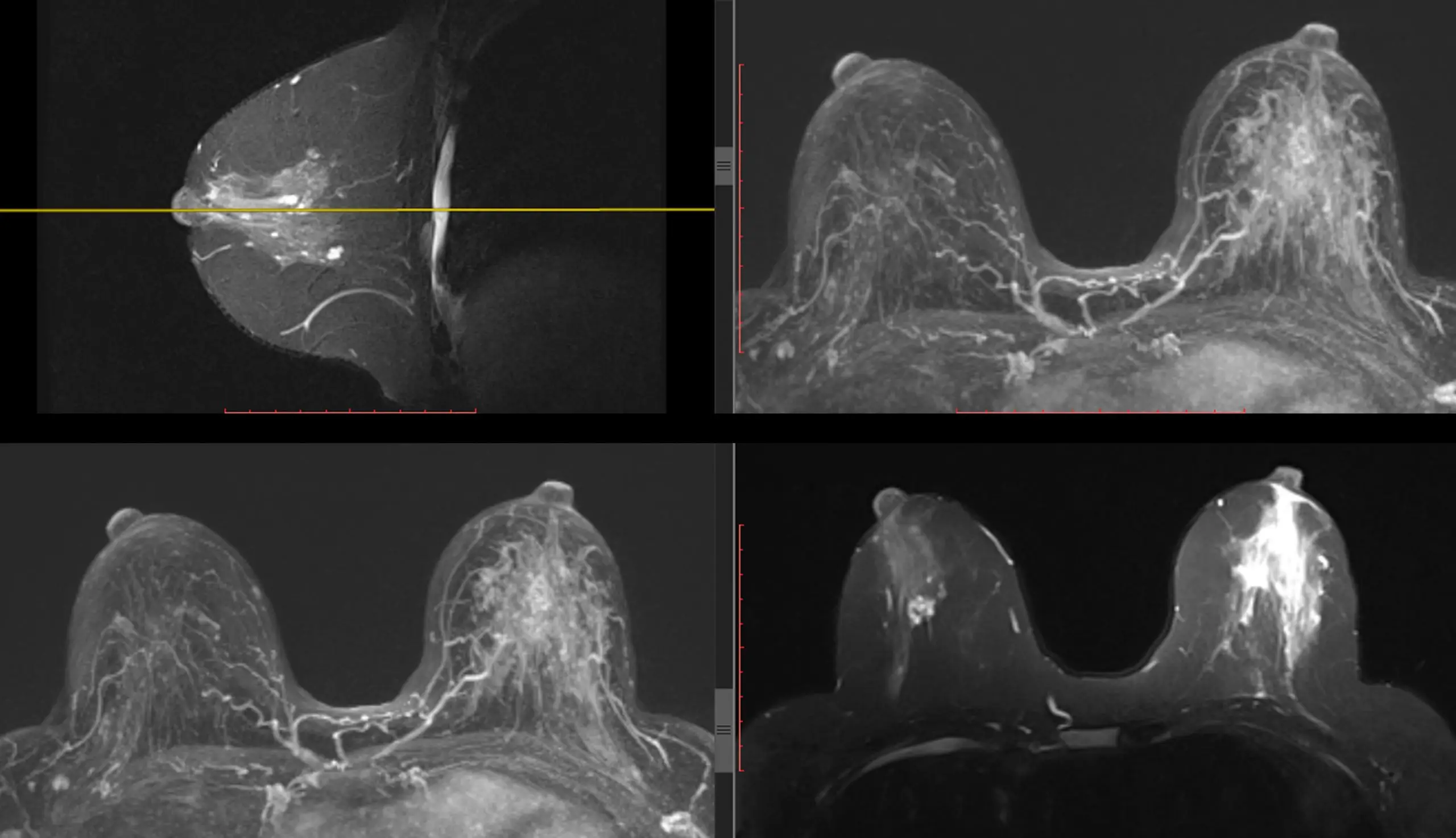 breast cancer screening comparison scaled