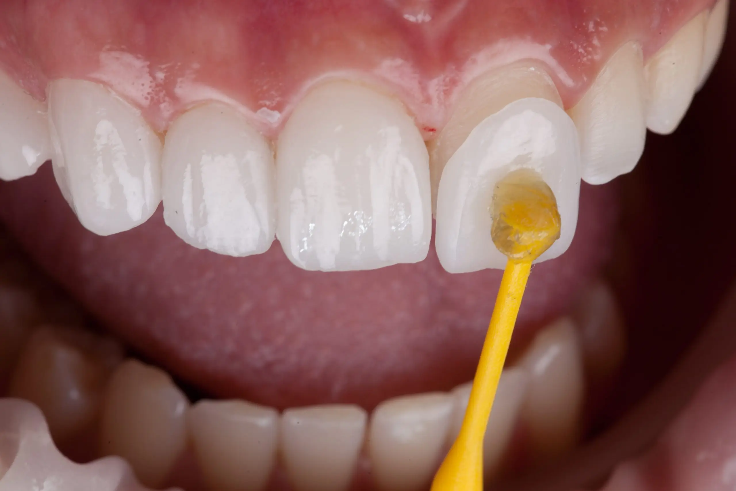 dental veneers treatment process scaled