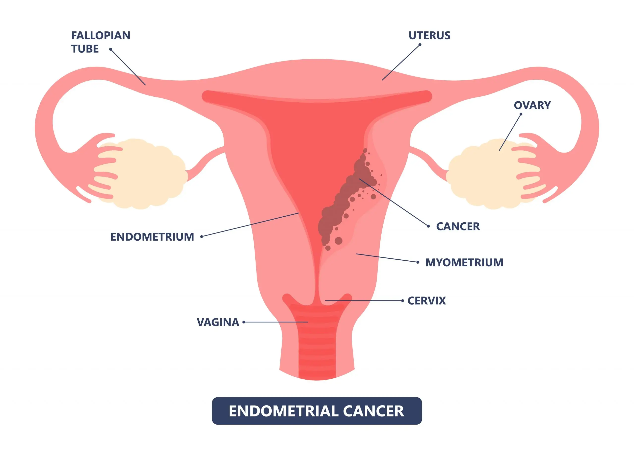 endometrial cancer overview disease definition scaled