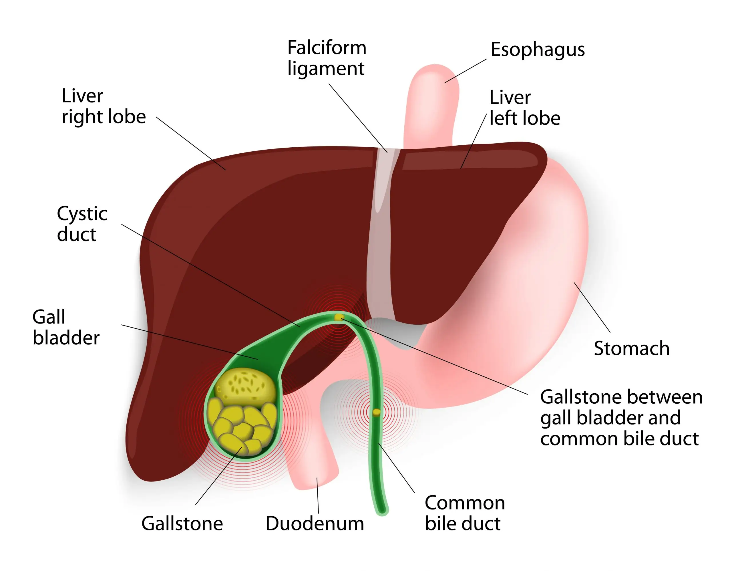 gallstones disease faq scaled