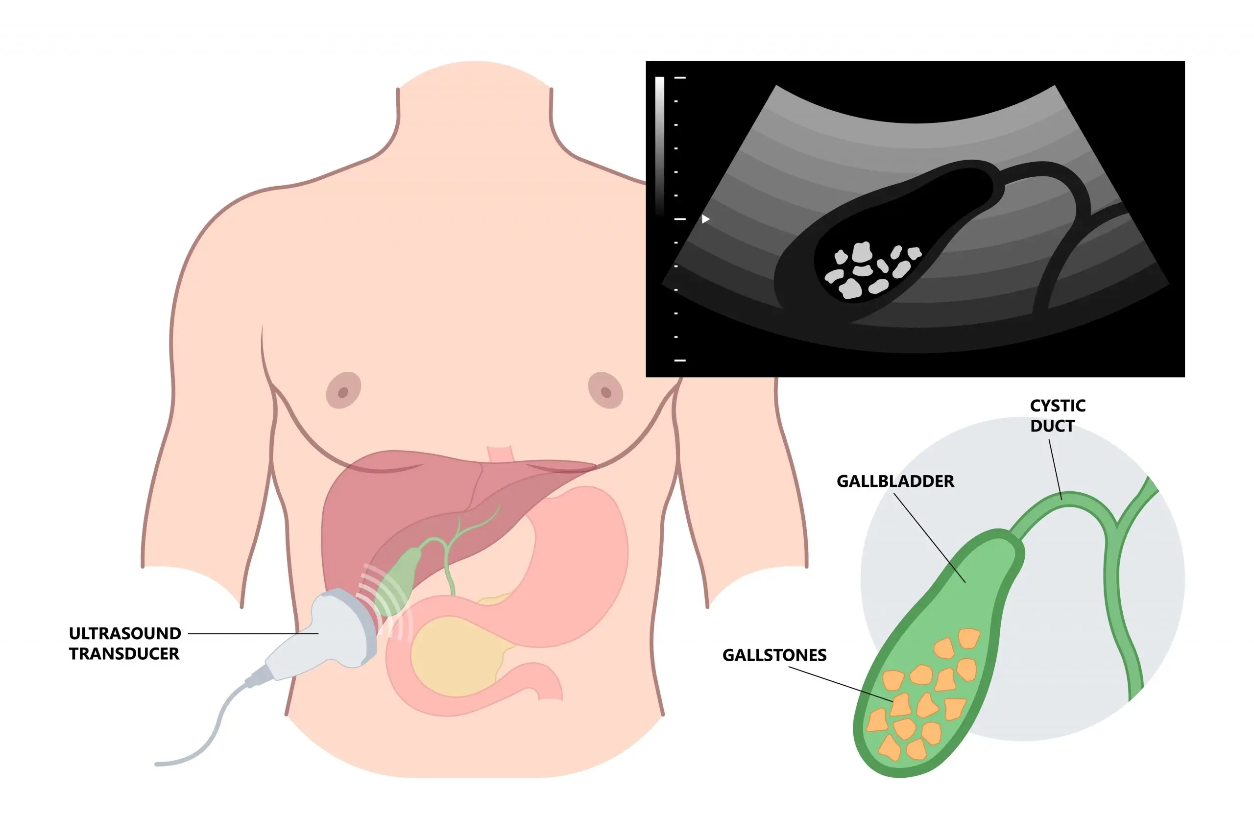 gallstones screening process scaled