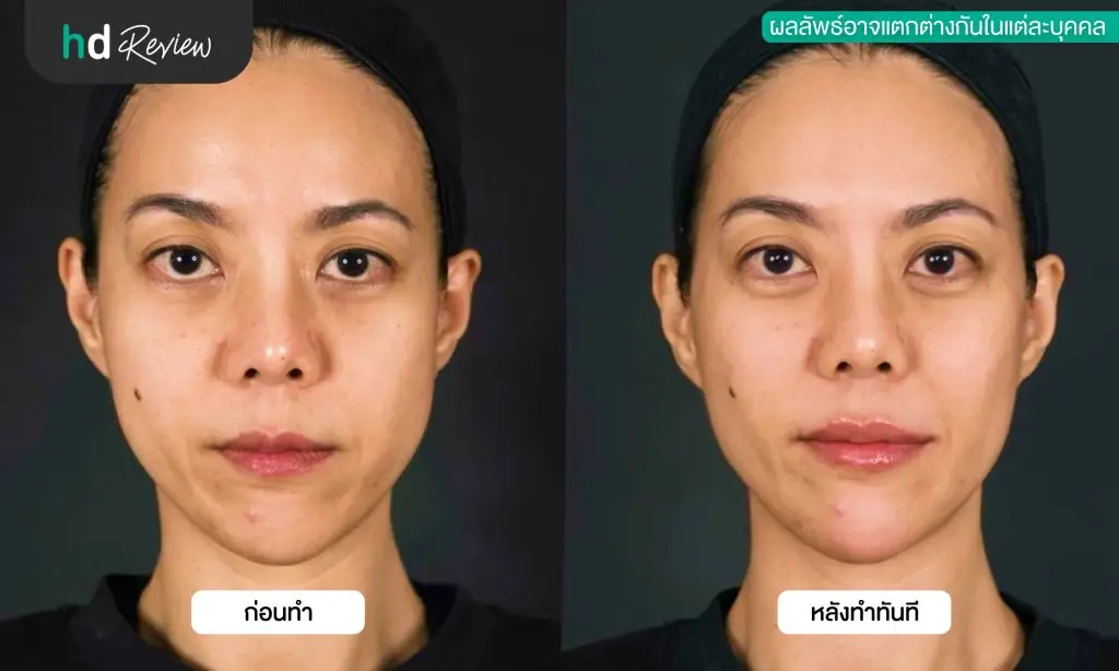 รีวิวโปรแกรมฉีดฟิลเลอร์ Definisse ปรับรูปหน้า แก้ปัญหาผิวคล้อย ที่ Hertitude Clinic