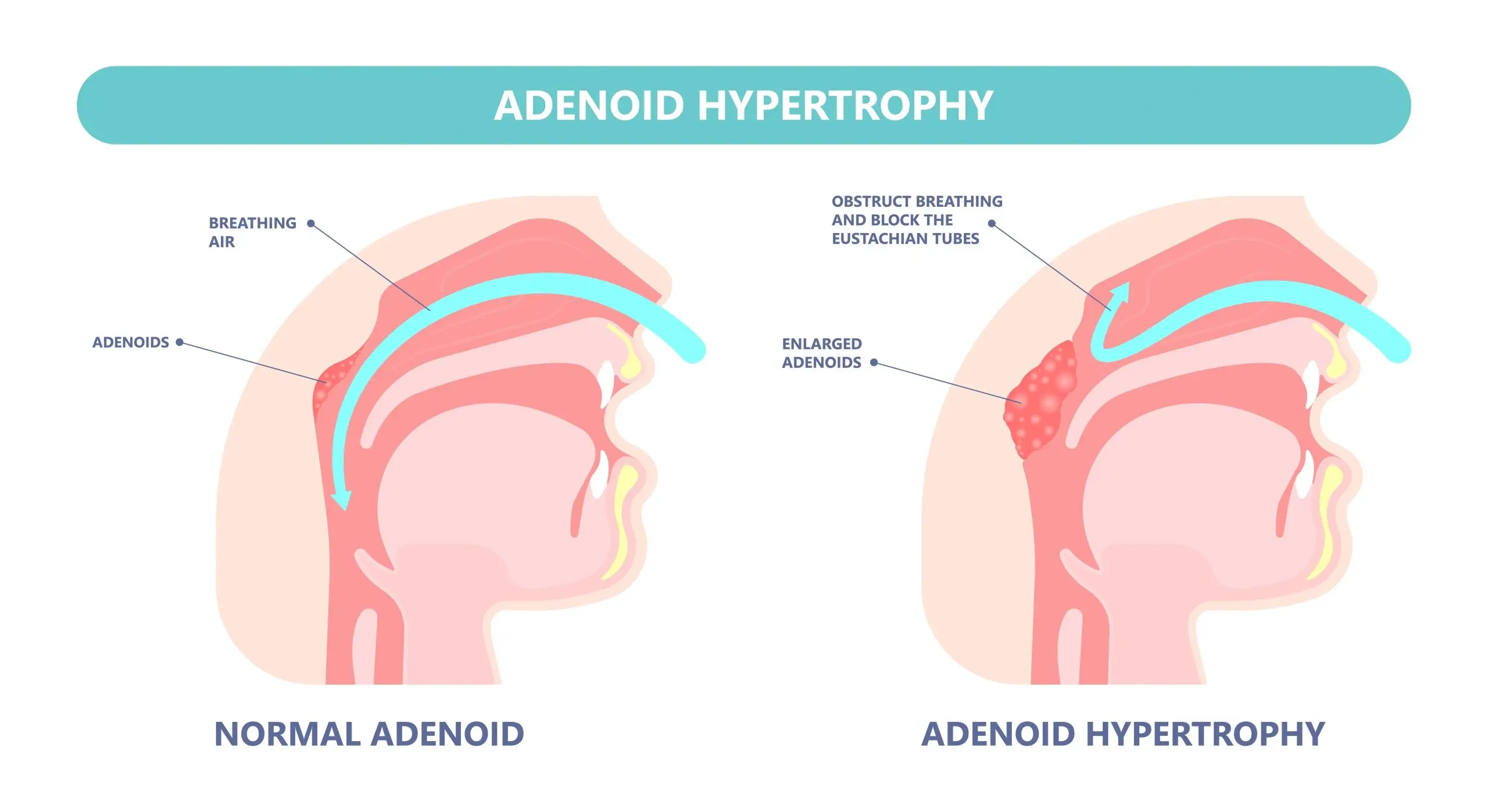 tonsil adenoid disease faq 01 scaled