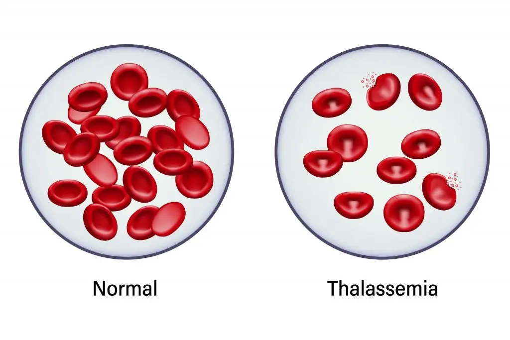 ทำความเข้าใจพาหะธาลัสซีเมียก่อนมีลูก พันธุกรรมโรคที่ส่งต่อได้