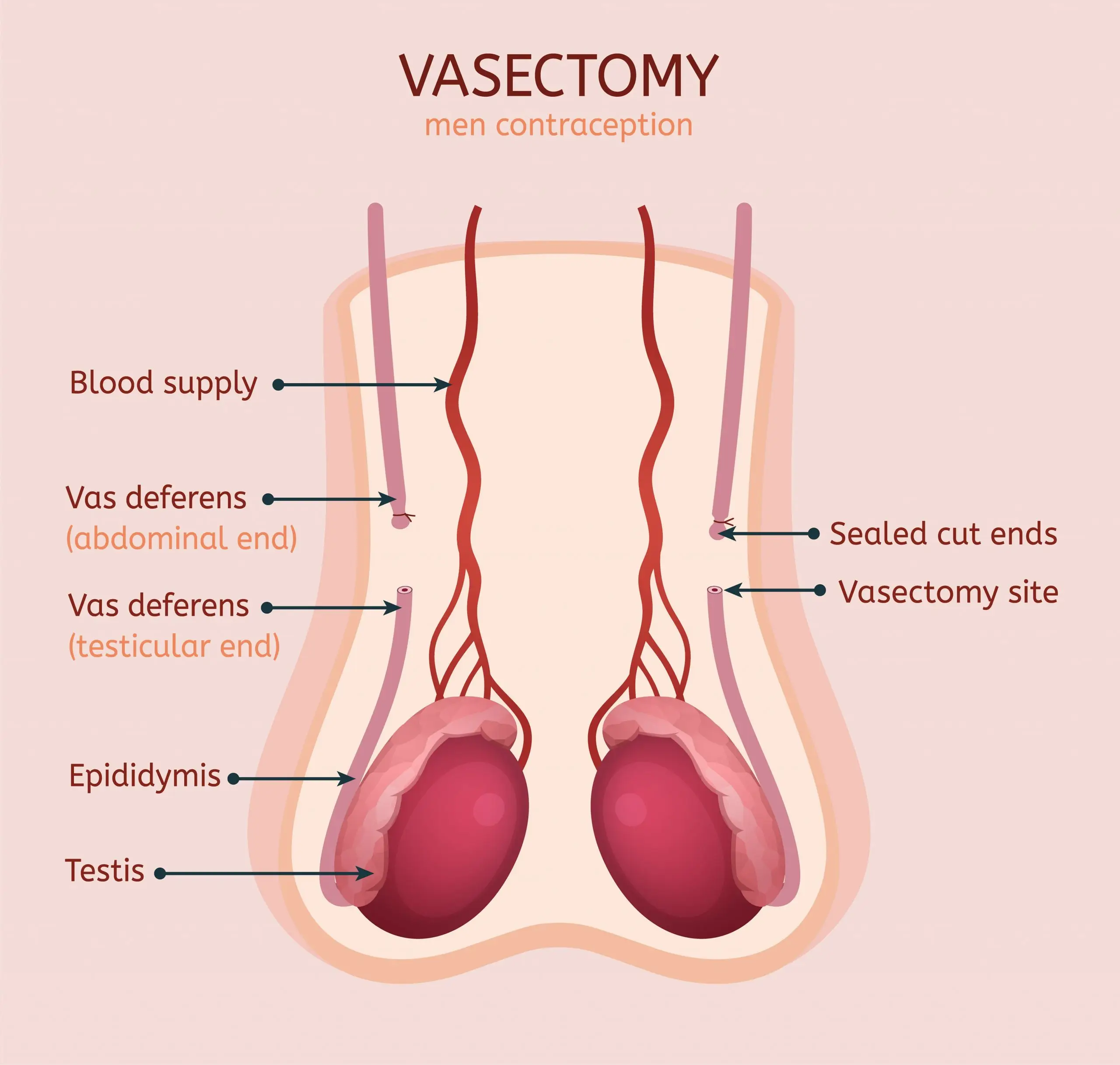 vasectomy disease faq scaled