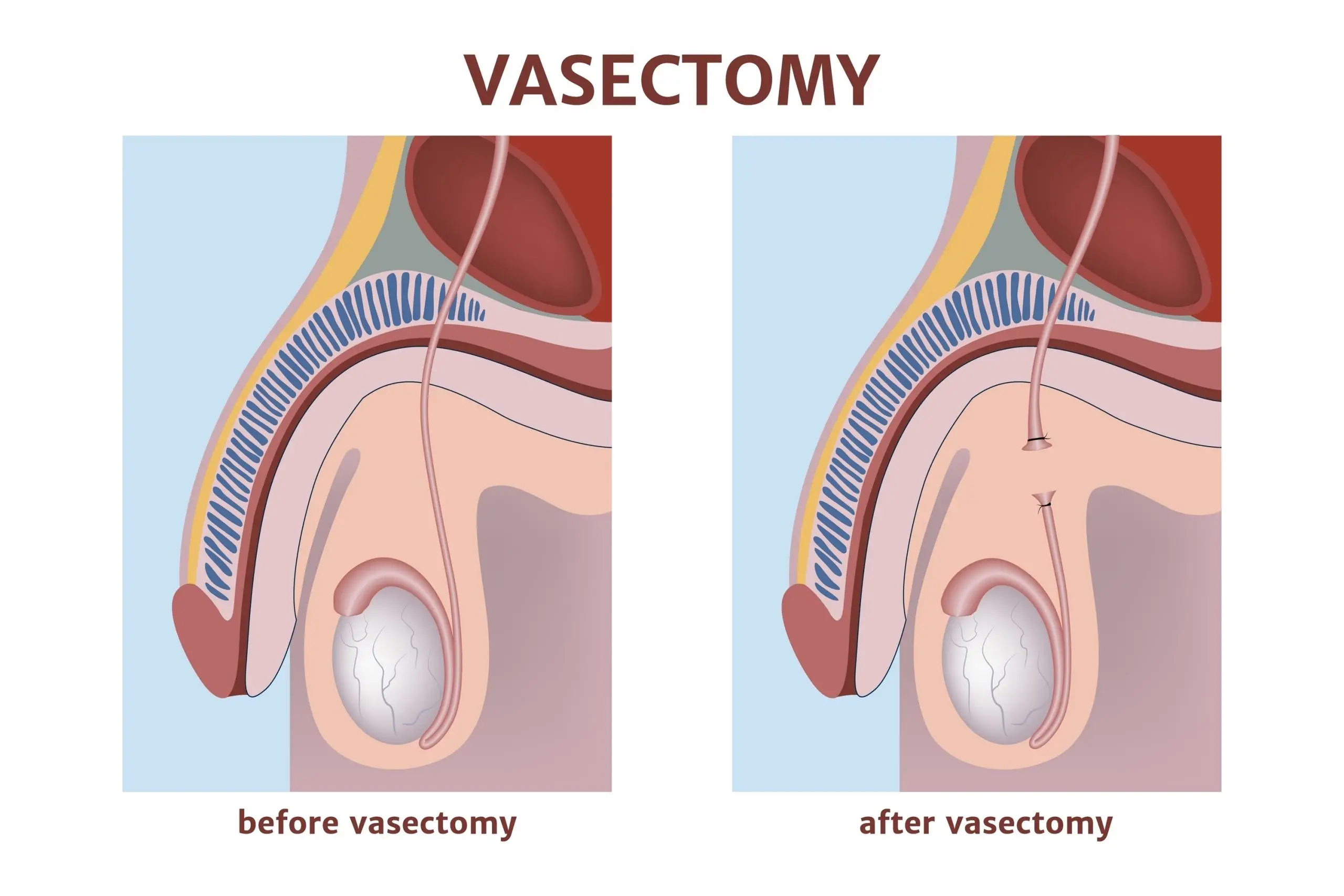 vasectomy treatment comparison scaled