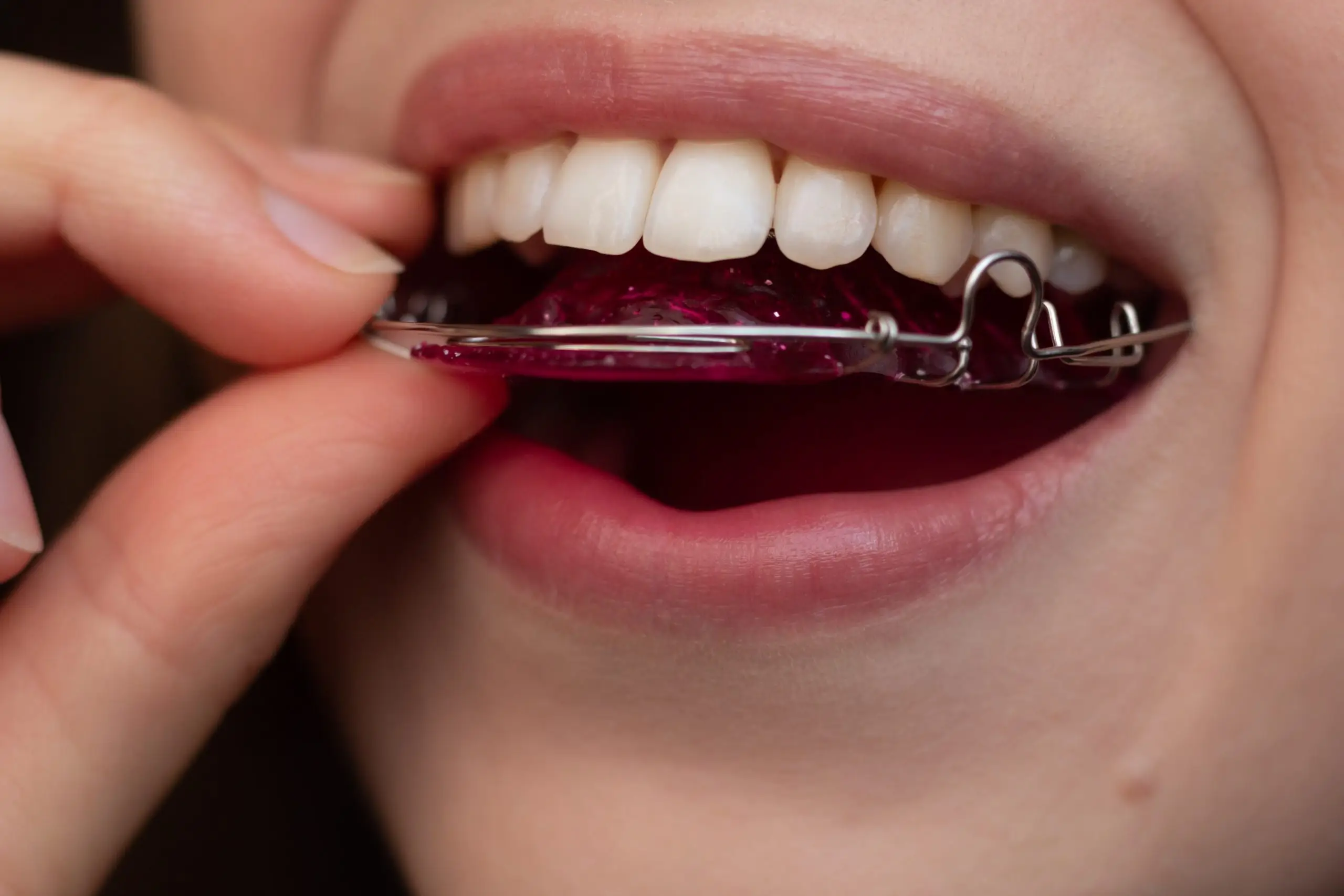 wearing retainers correctly treatment how to scaled