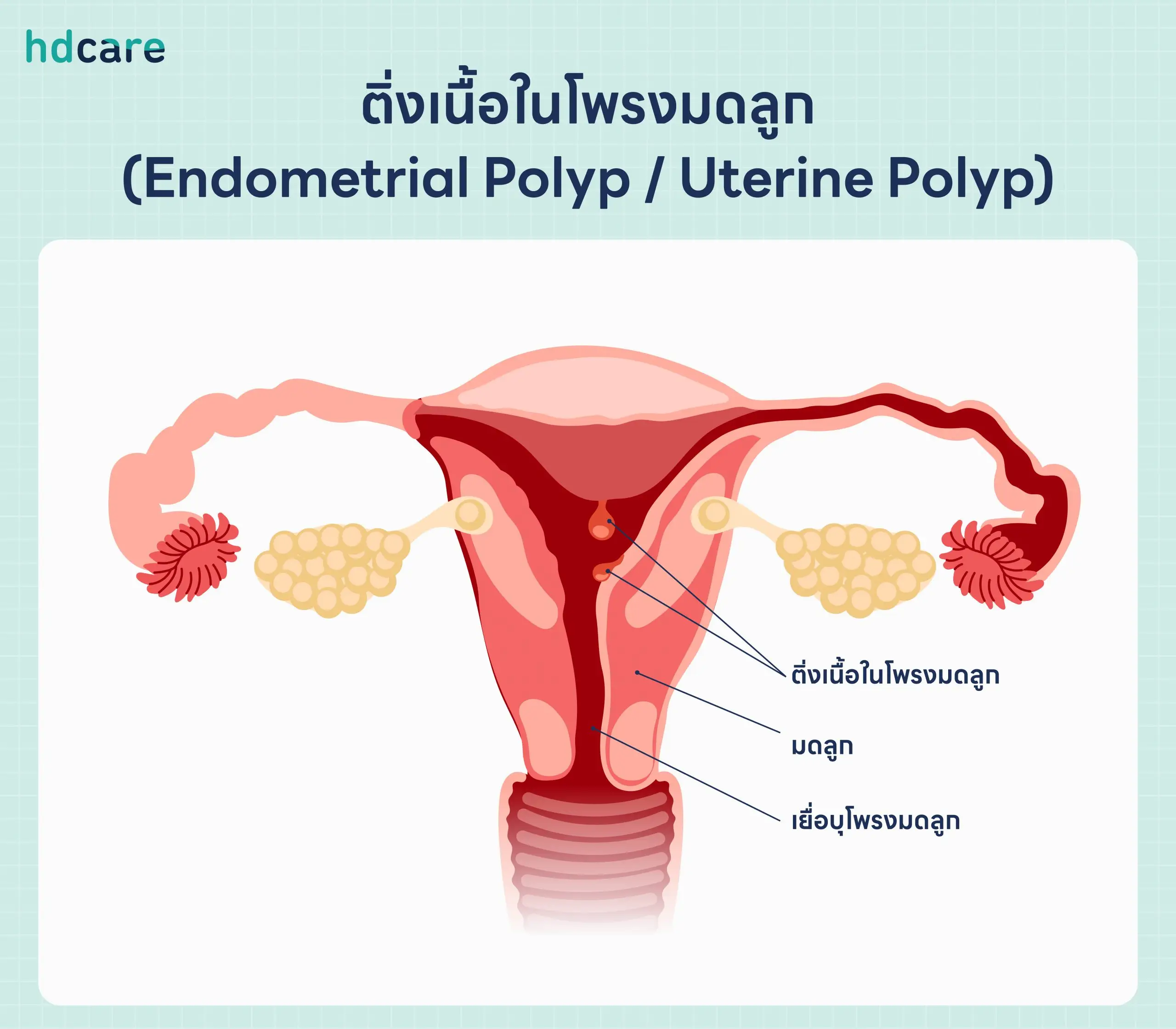 Uterine-Polyp-scaled