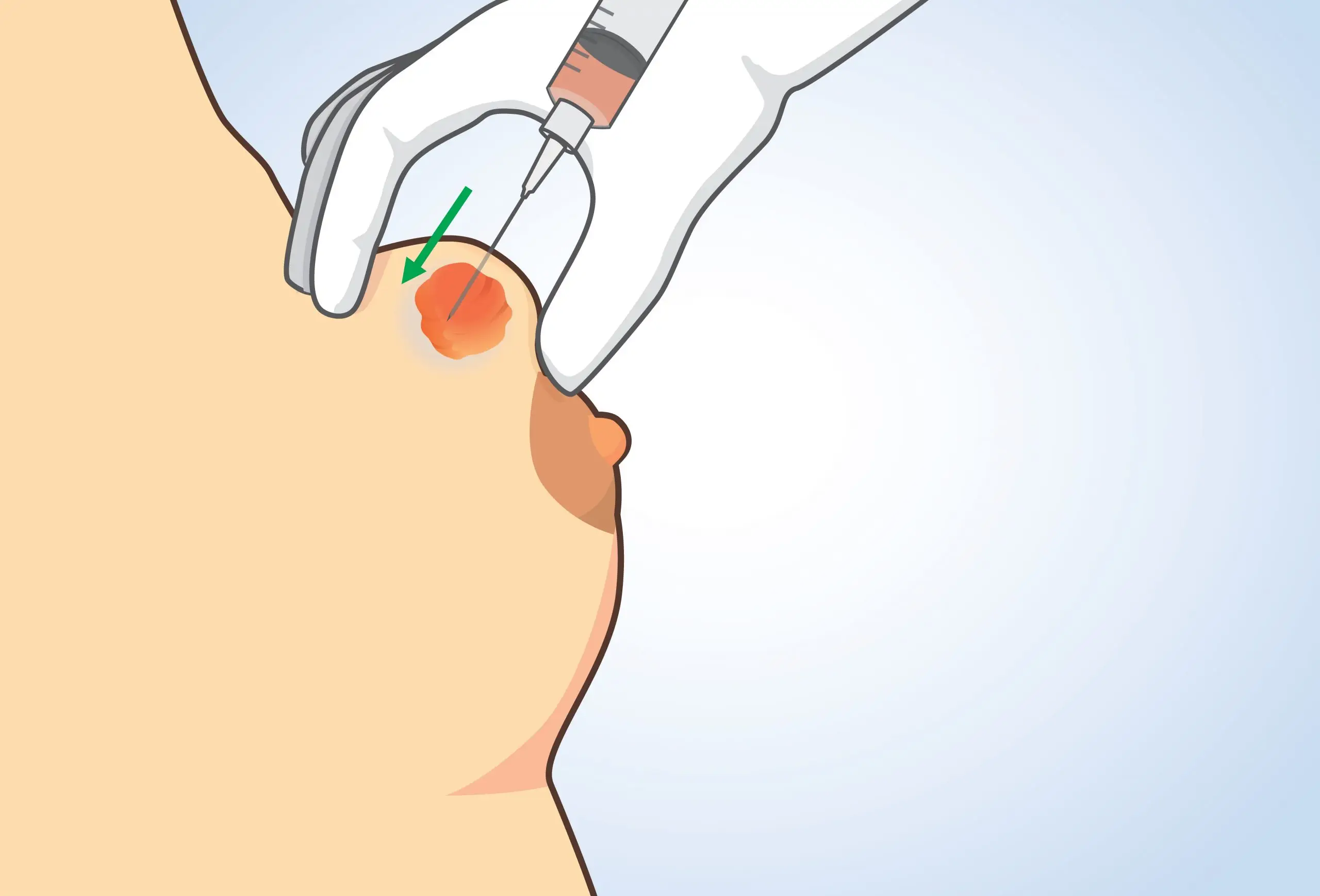 breast tumor cyst treatment comparison scaled