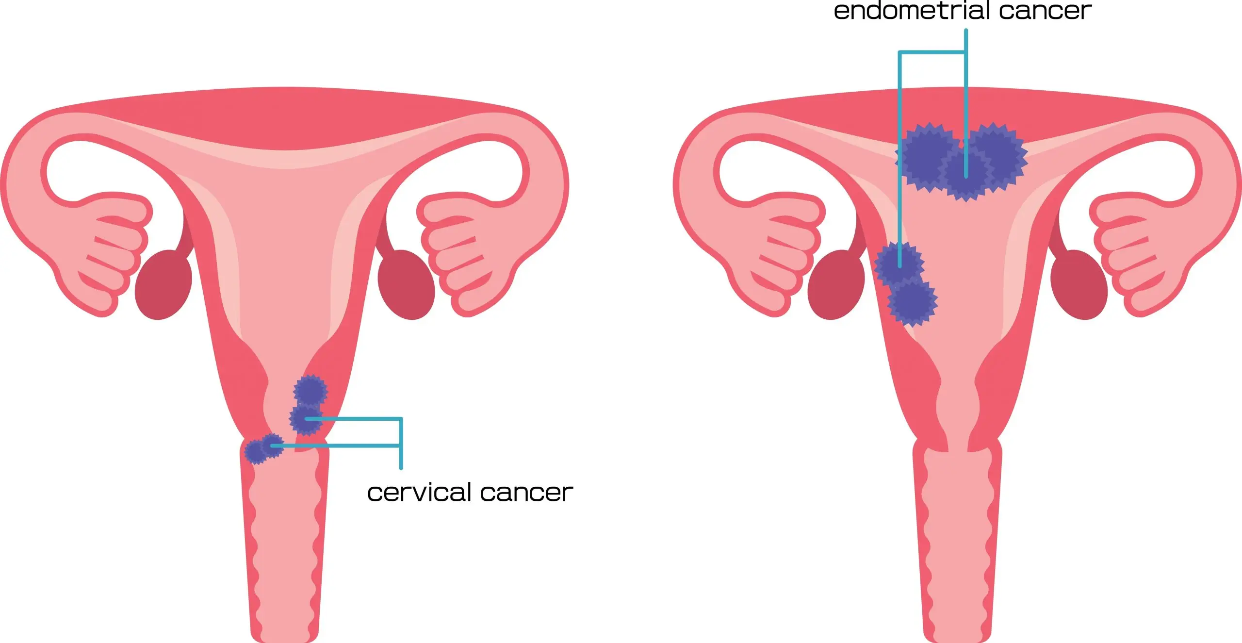 cancer uterine cervical disease definition scaled