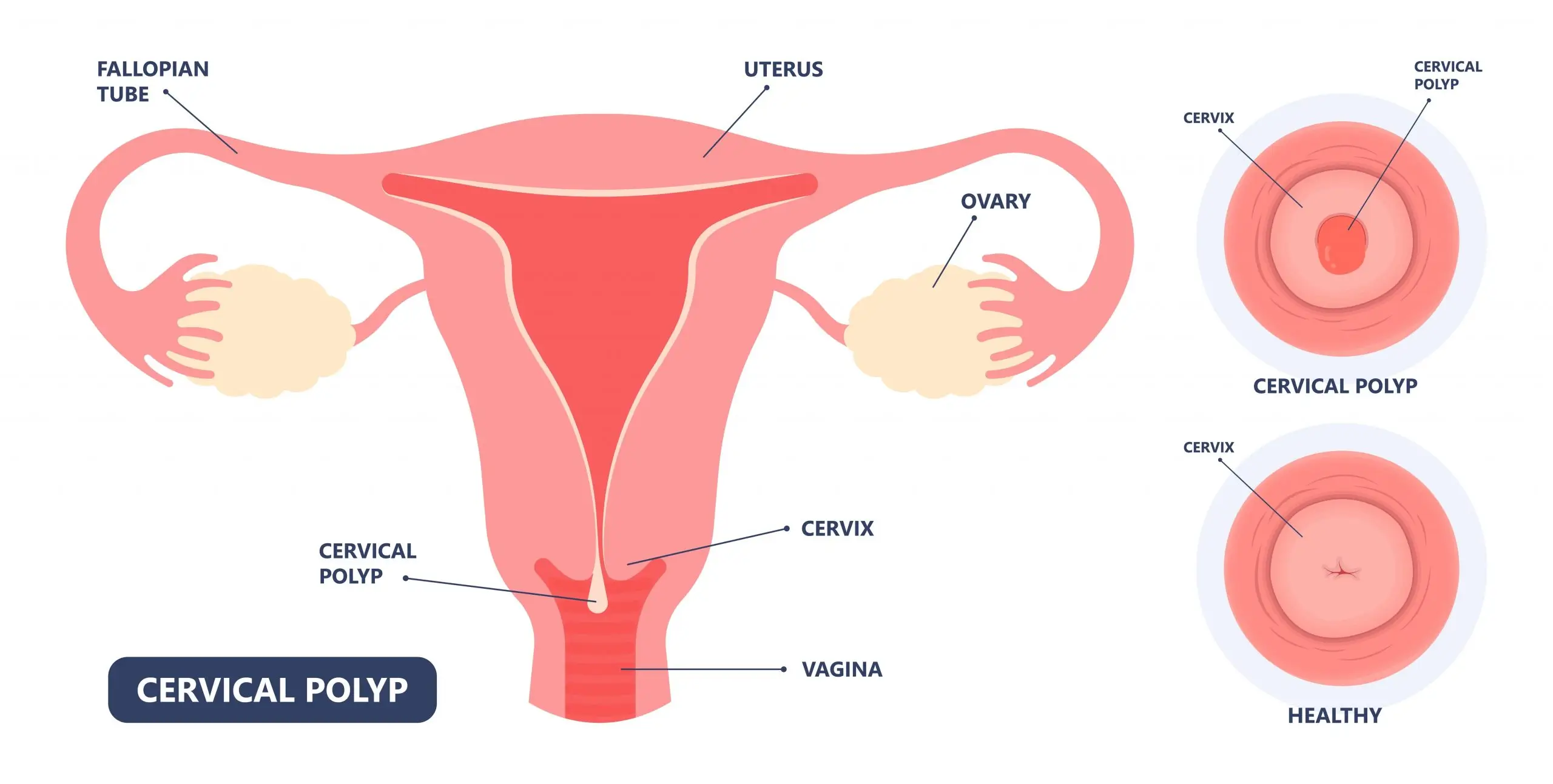 cervical polyp treatment faq scaled