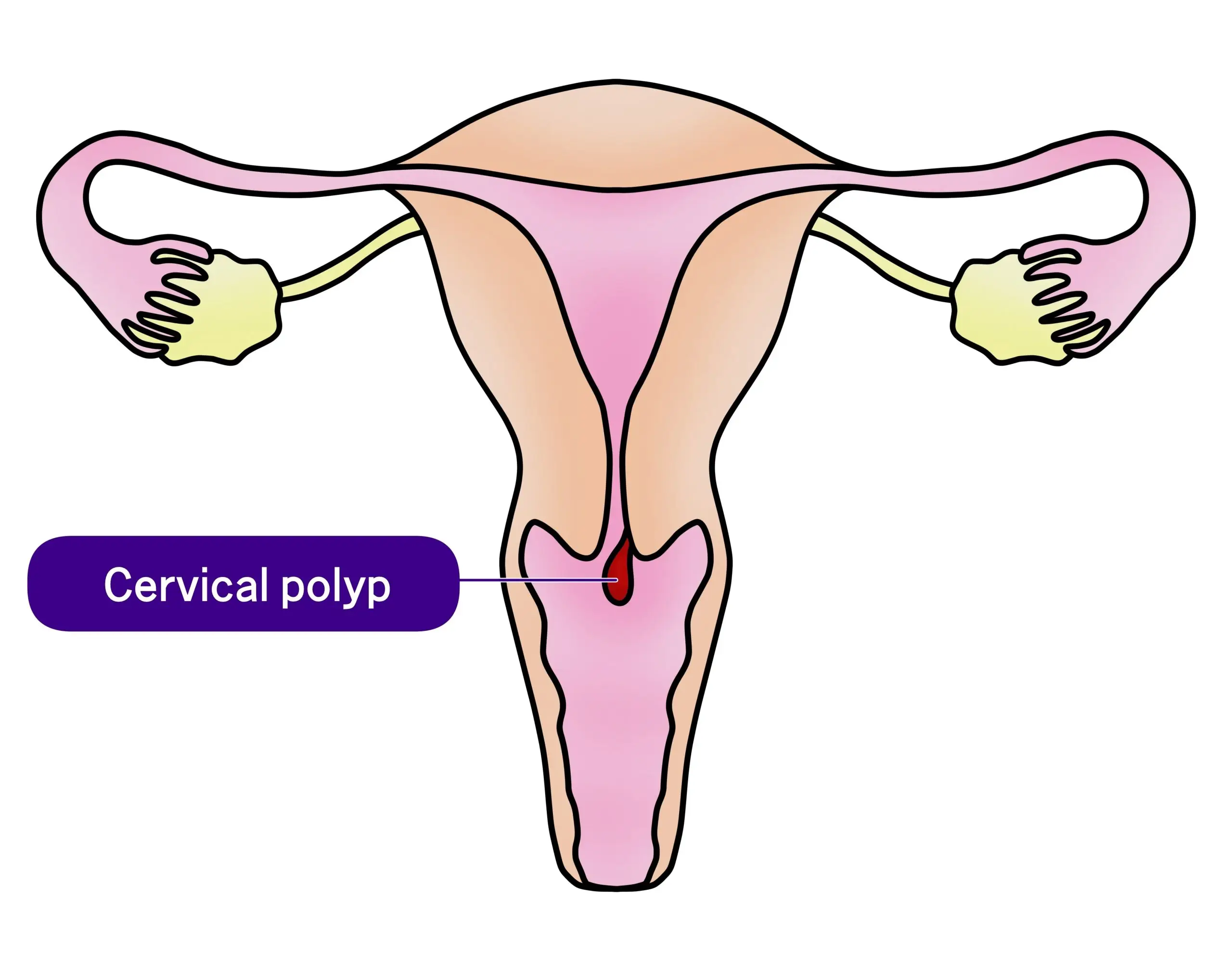 cervical polyp treatment process scaled