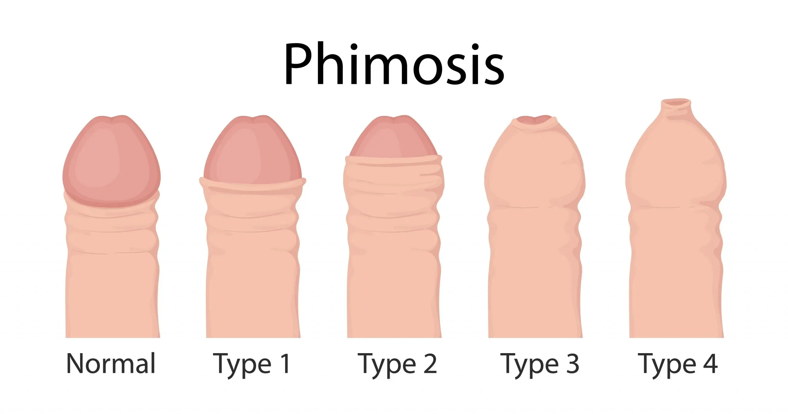 phimosis disease definition scaled