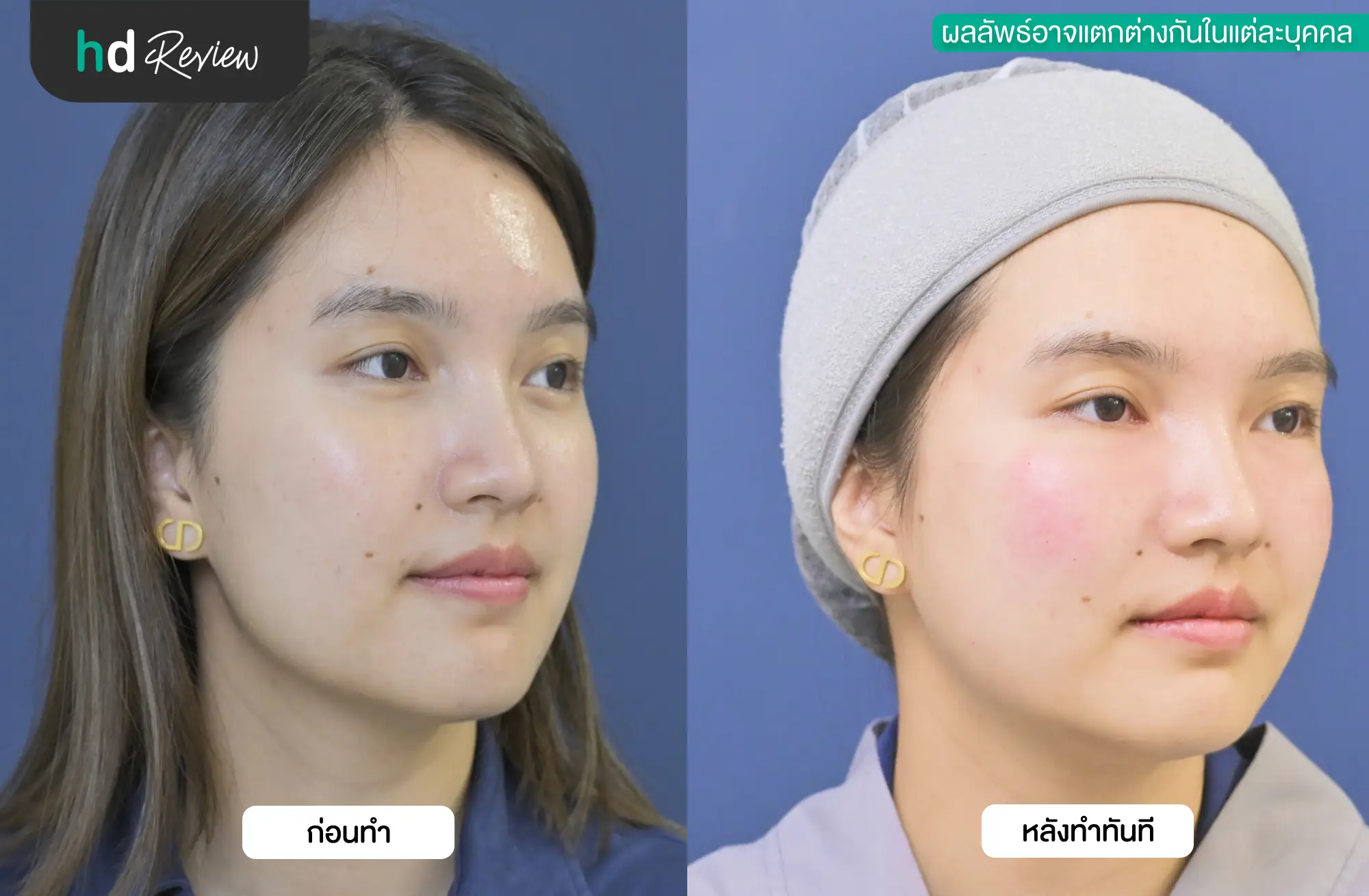 ผลลัพธ์หลังฉีด GlowLifting