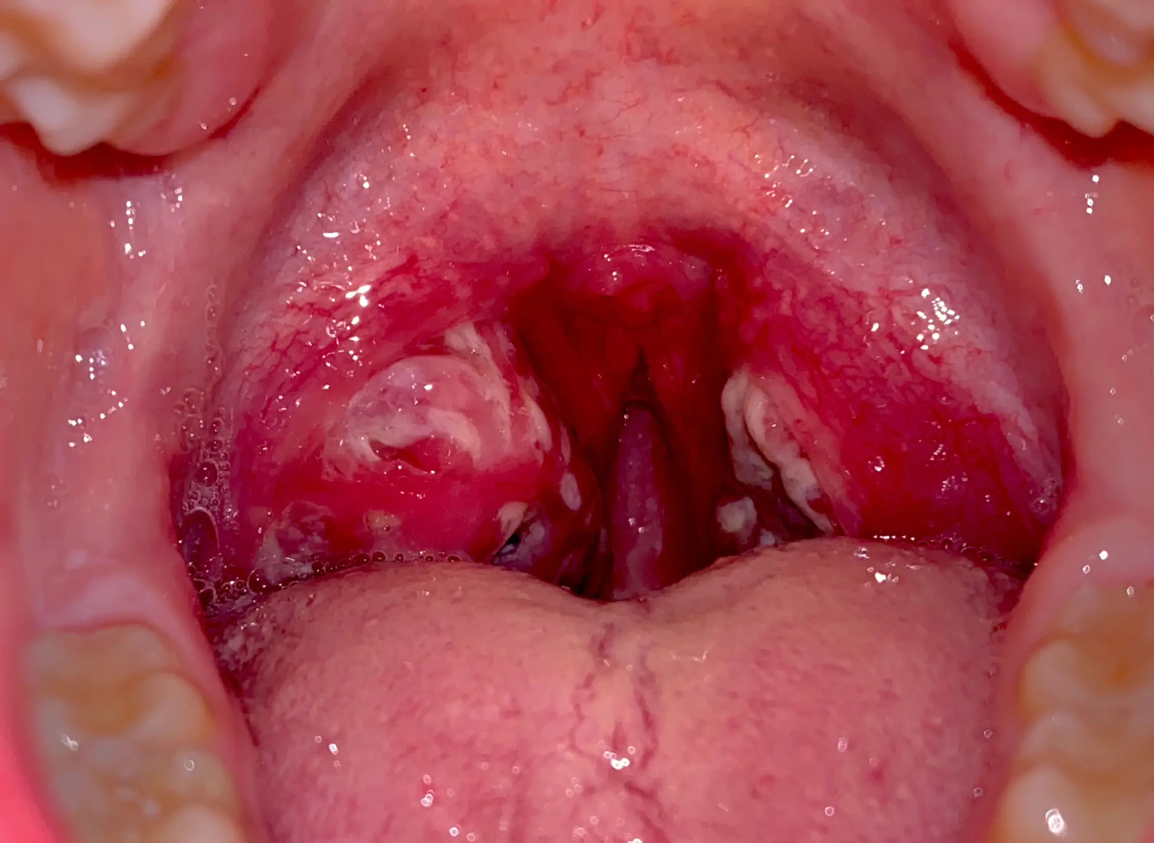 tonsil screening selfcheck