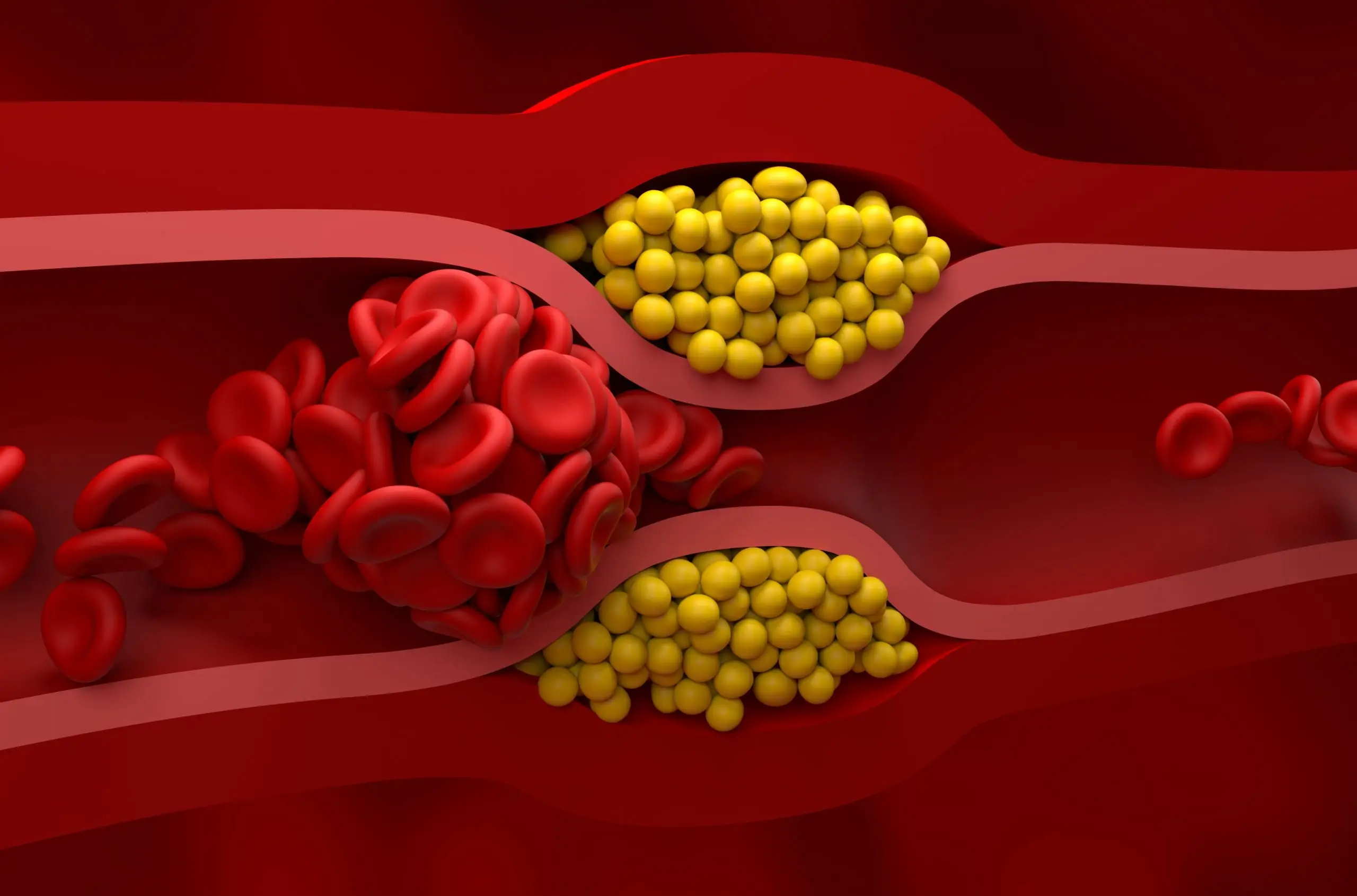 triglycerides disease definition scaled