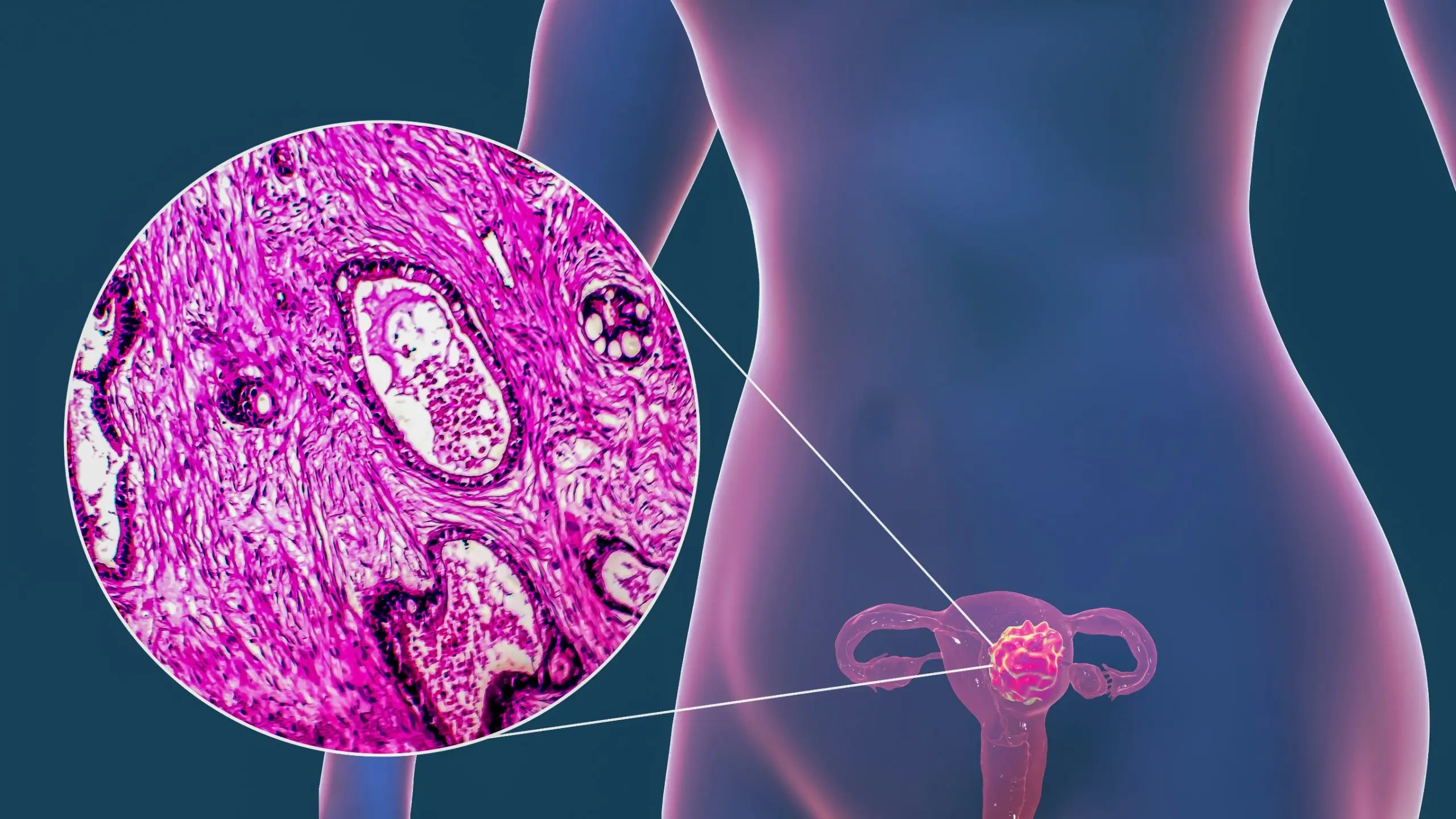 uterine cancer disease definition scaled