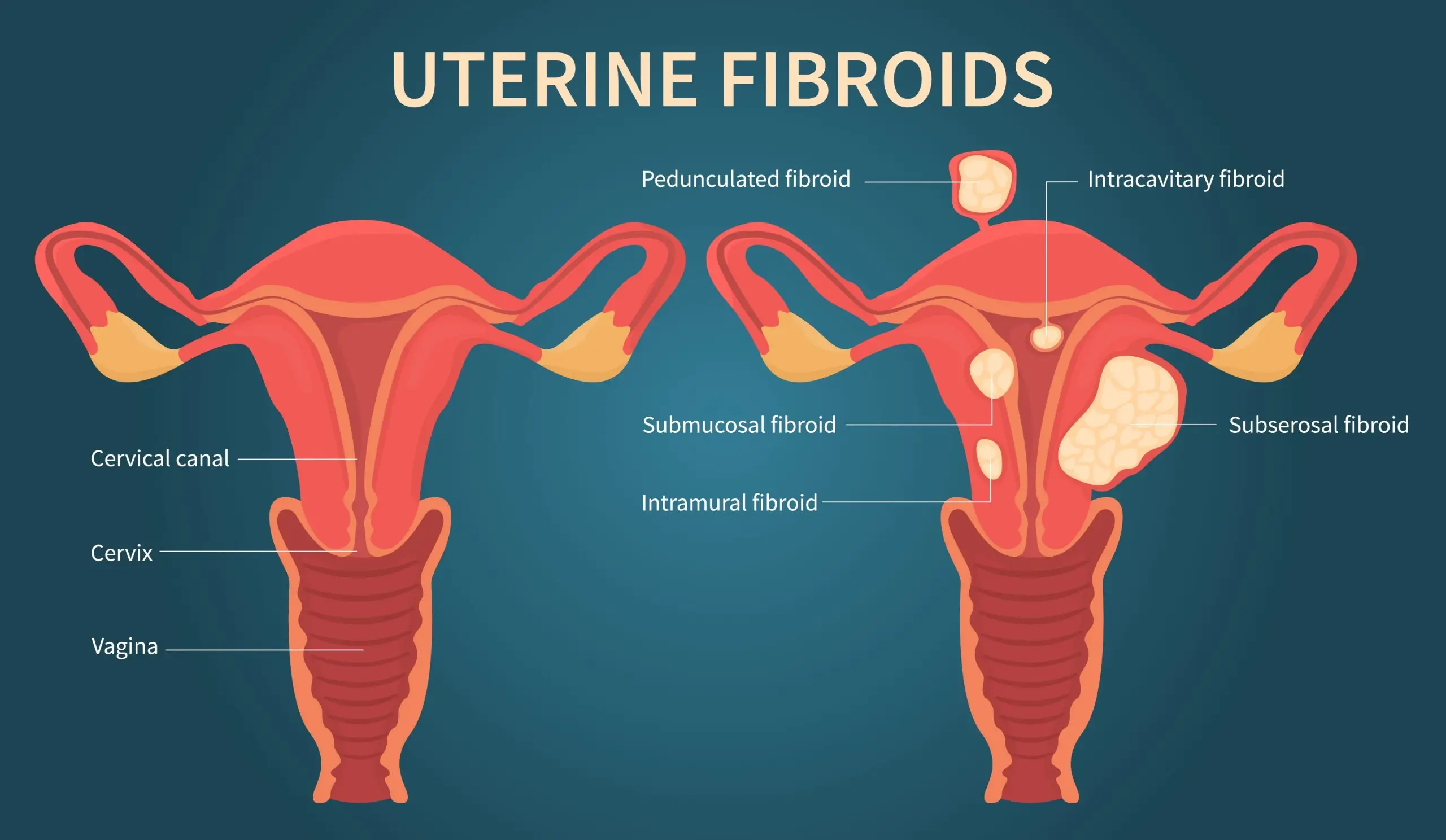 uterine fibroids disease definition 02 scaled