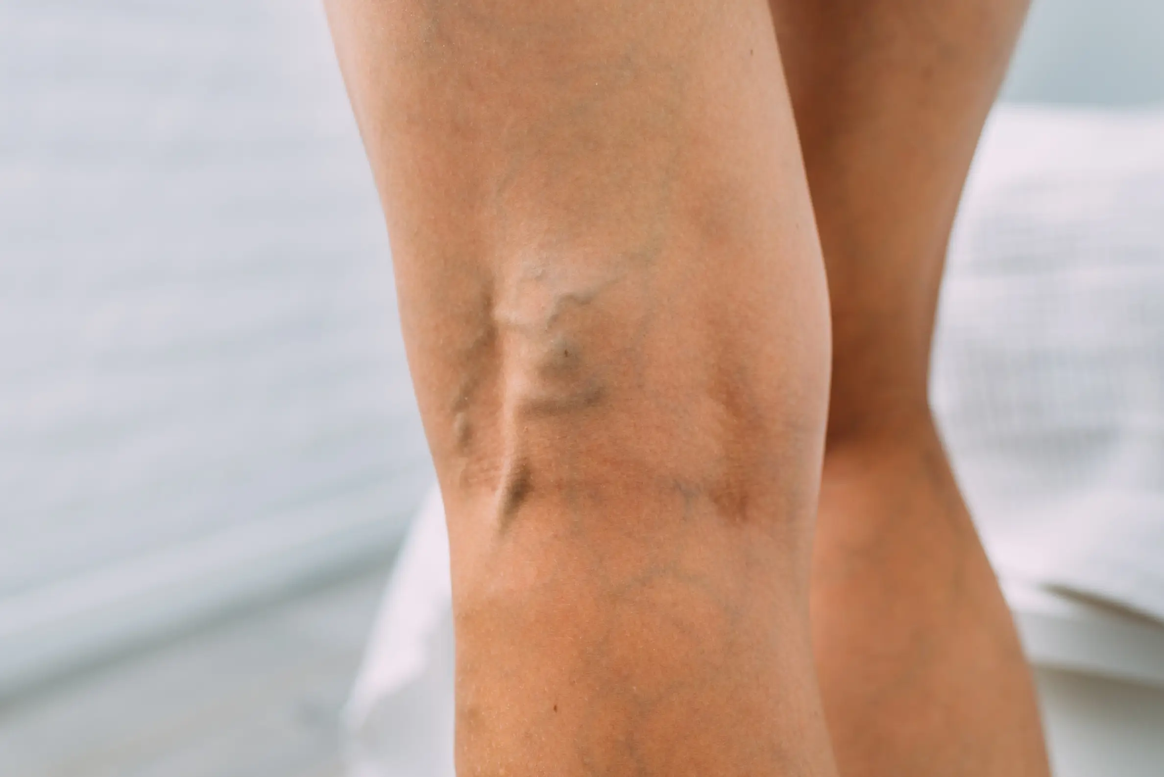 varicose vein prevention treatment how to