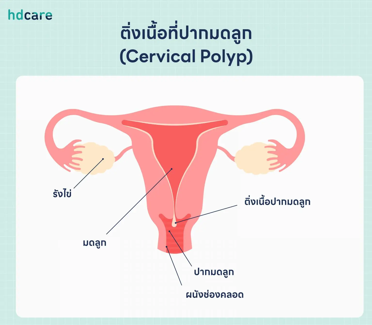 ติ่งเนื้อที่ปากมดลูก คืออะไร ร้ายแรงไหม สาเหตุ อาการ วิธีรักษา ติ่งเนื้อที่ปากมดลูก C