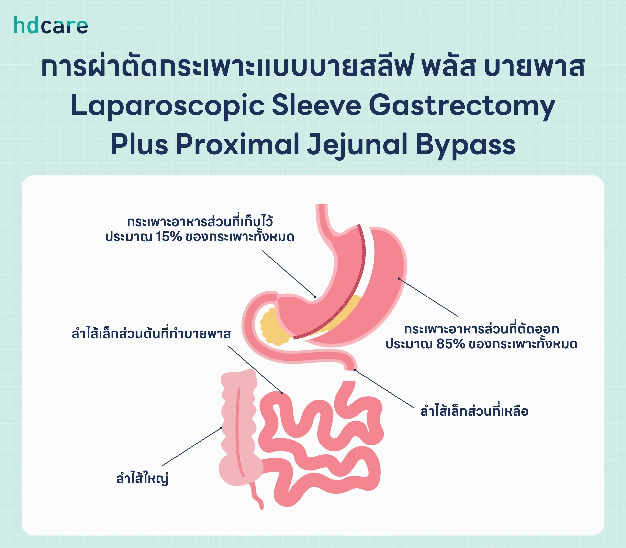 บายสลีฟ พลัส บายพาส