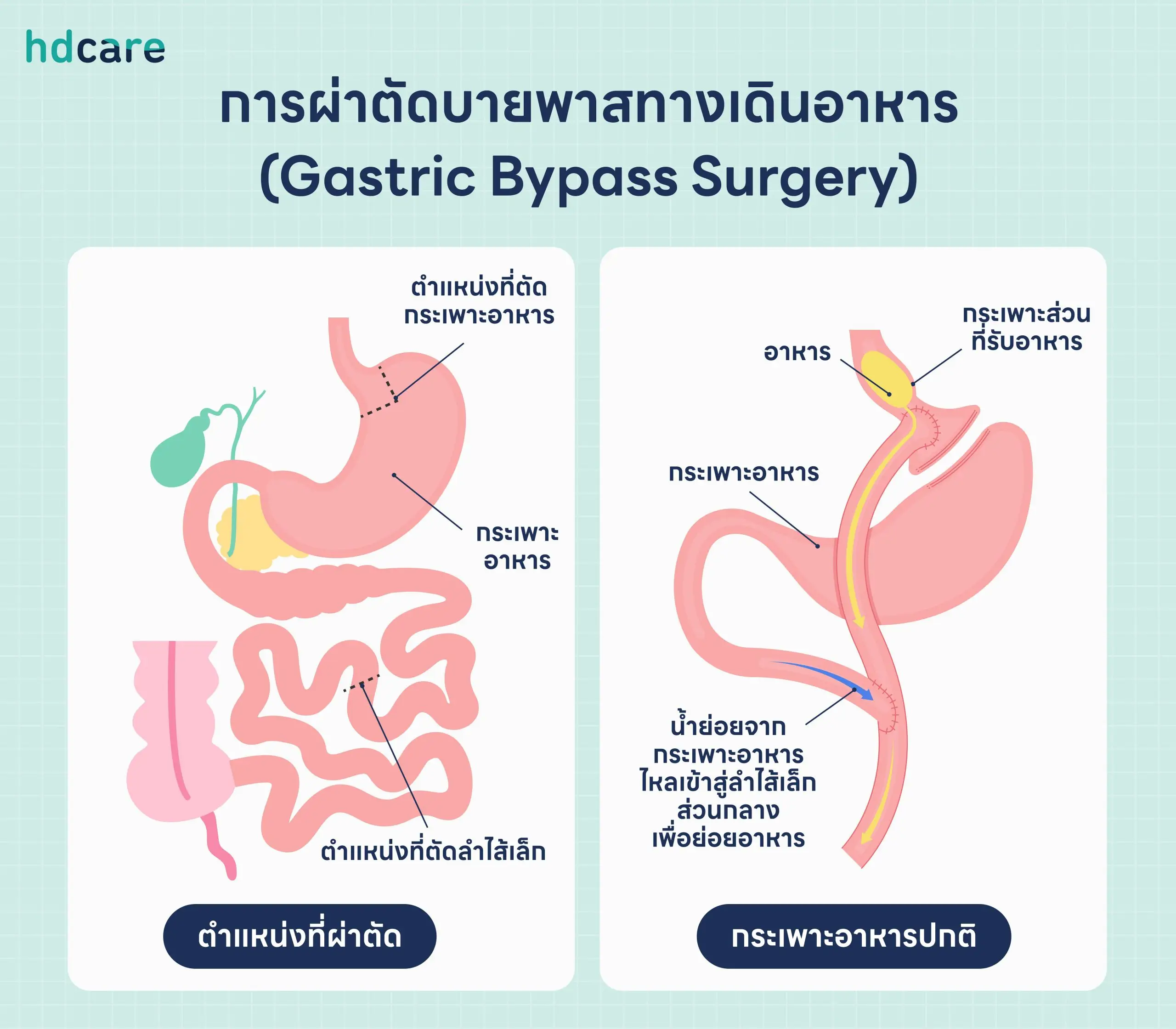 ผ่าตัดบายพาส