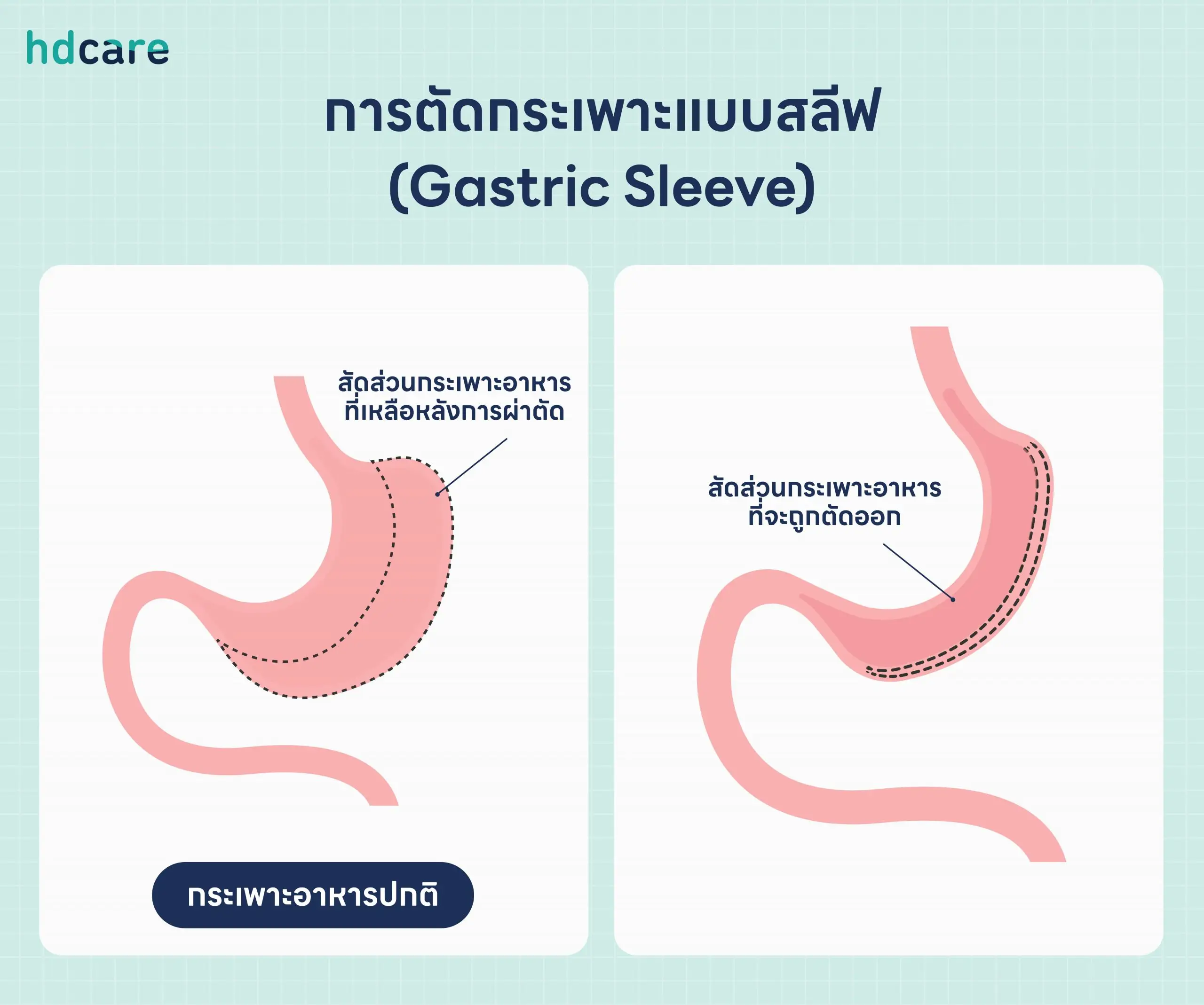 ผ่าตัดแบบสลีฟ