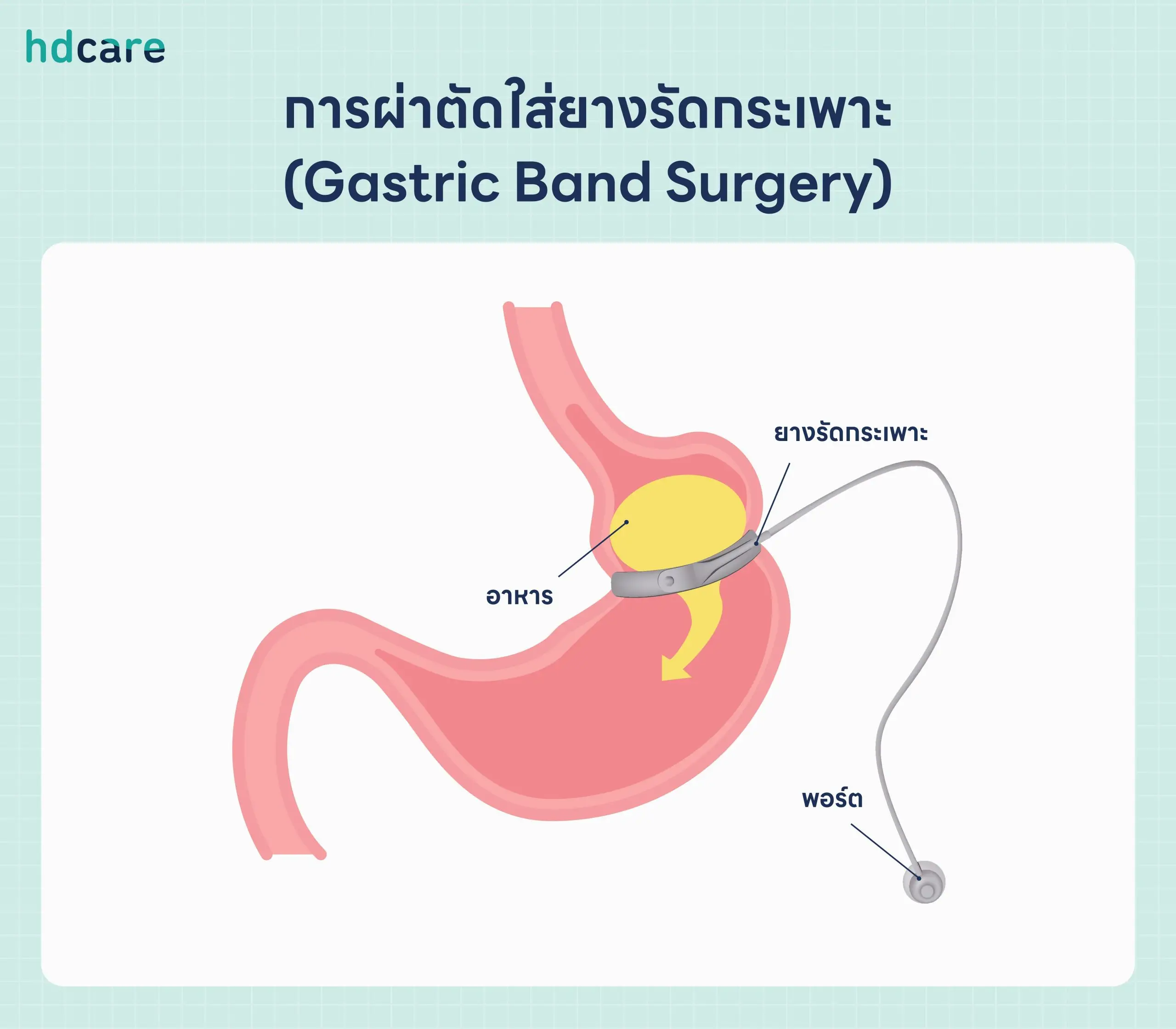 ผ่าตัดใส่ยาง