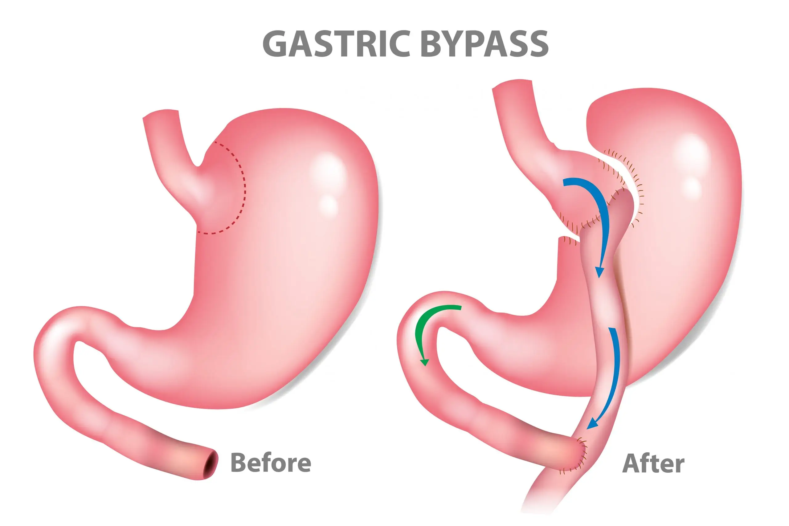 bariatric affect body treatment faq scaled