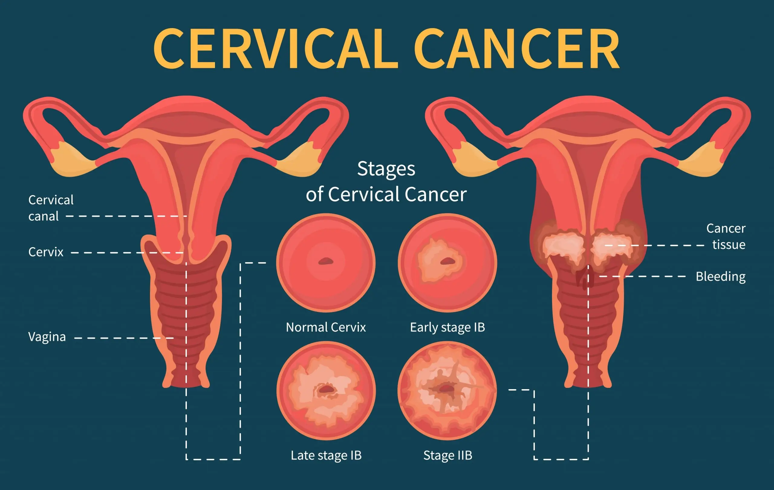 cervical cancer symptoms treatment prevention scaled