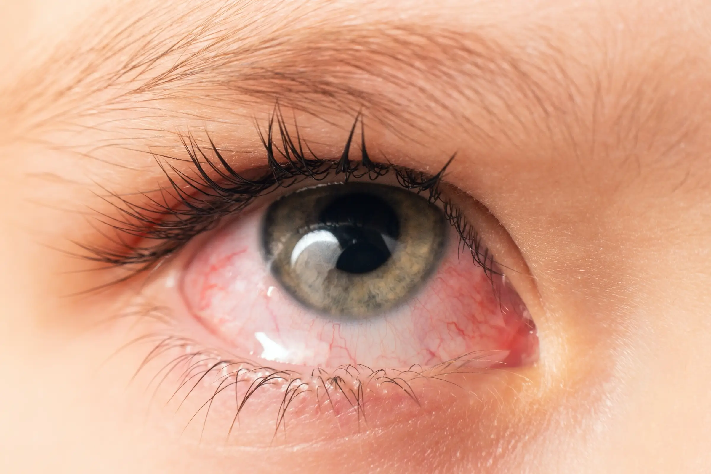 conjunctivitis symptoms treatment prevention