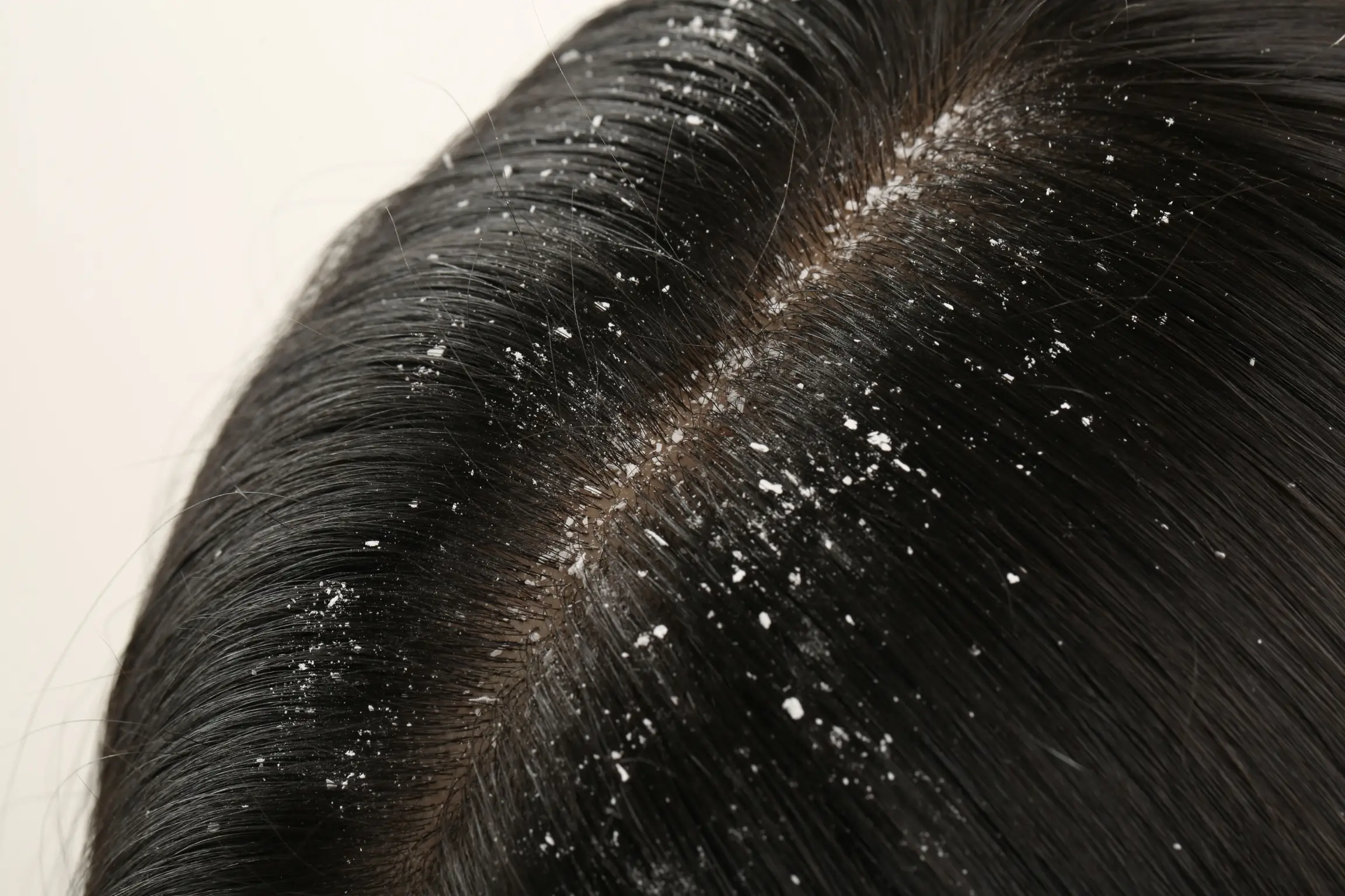 dandruff can cause hair loss