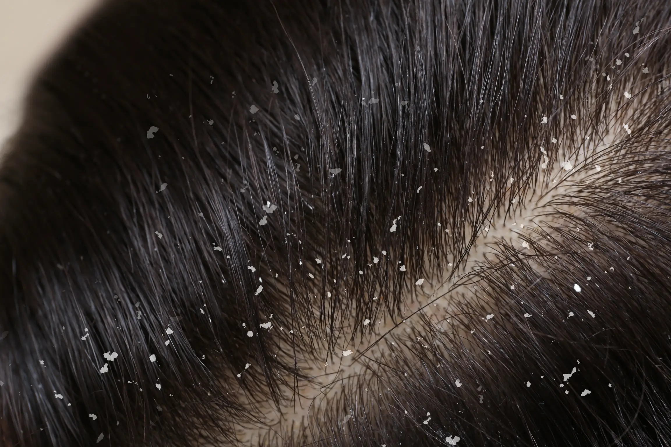 dandruff causes symptoms