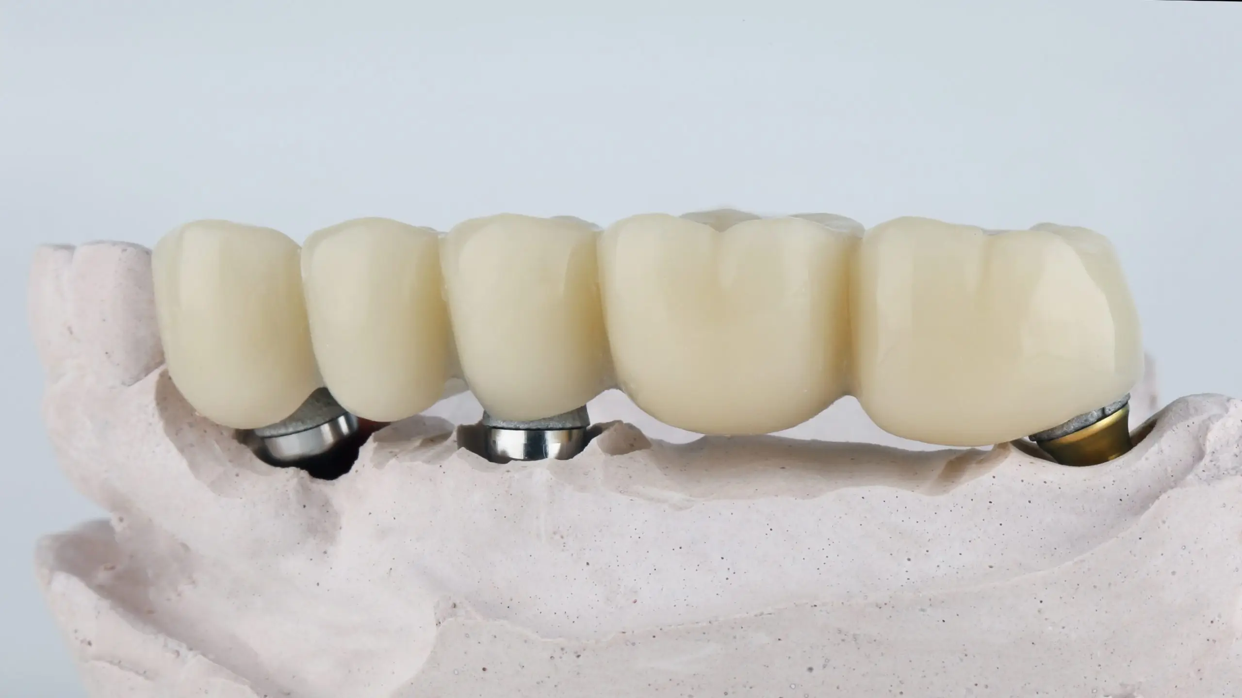 dental bridge type scaled