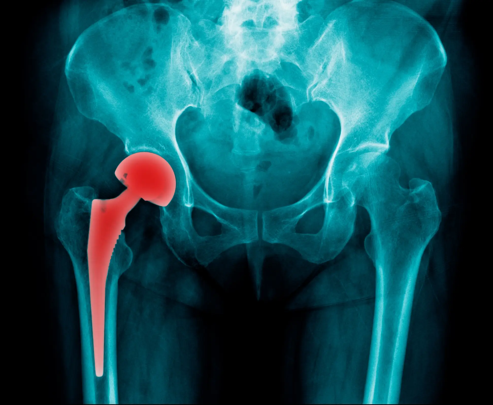 hip arthroplasty