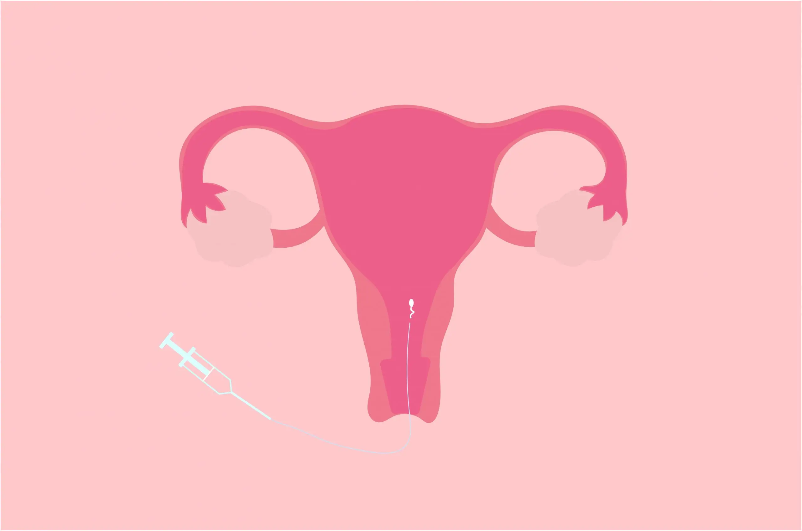 intrauterine insemination iui 1 scaled