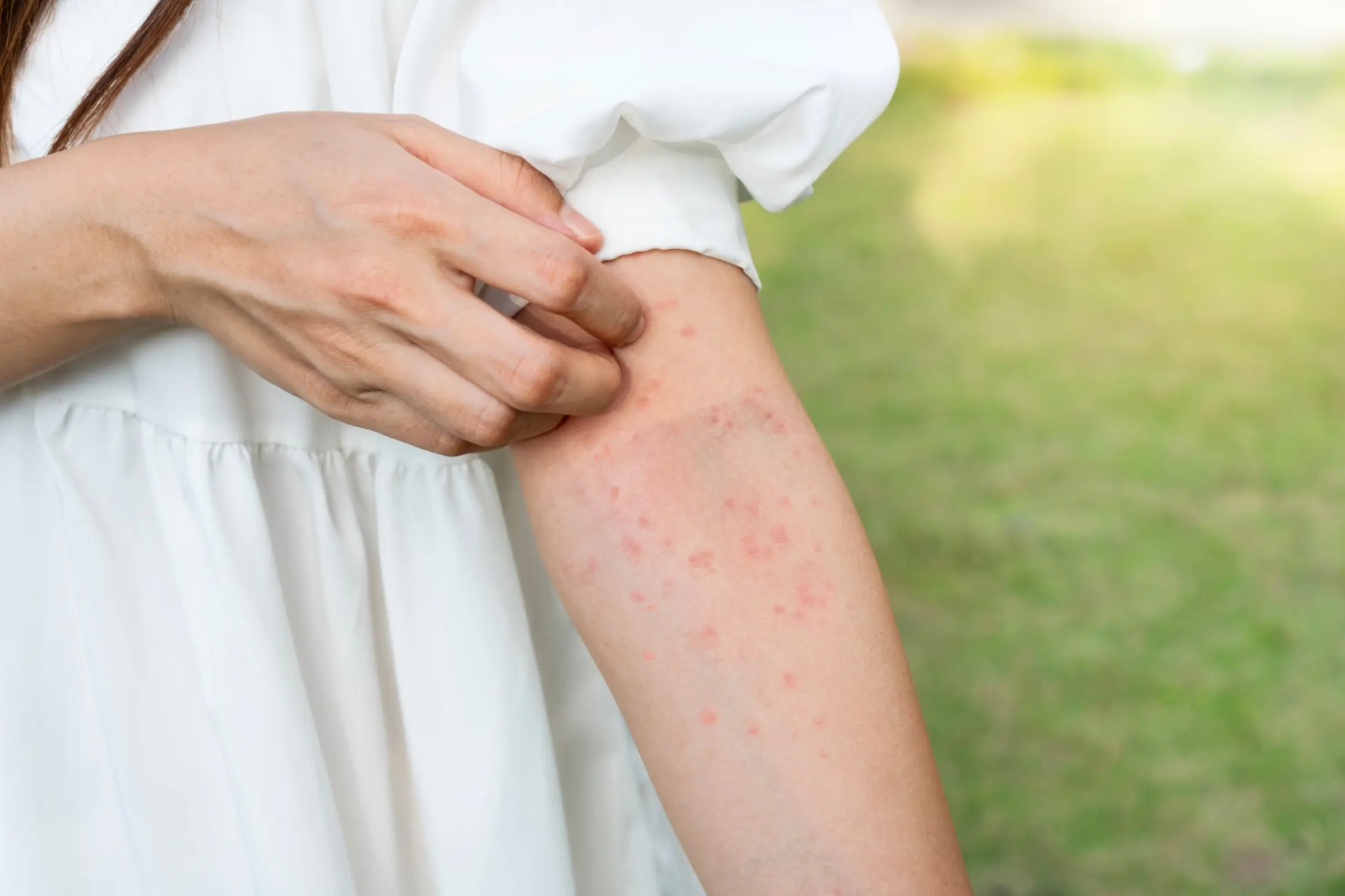 rash common in summer prevent with herbs