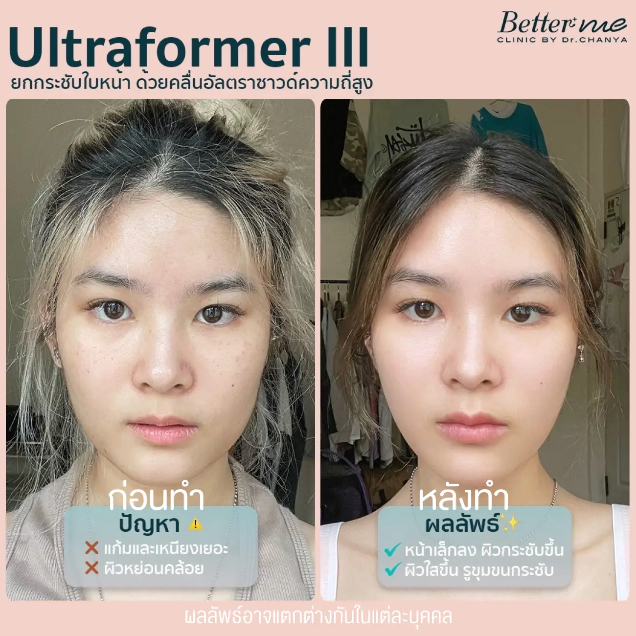 รีวิว Ultraformer III ที่ Better Me Clinic by Dr. Chanya รูป 2